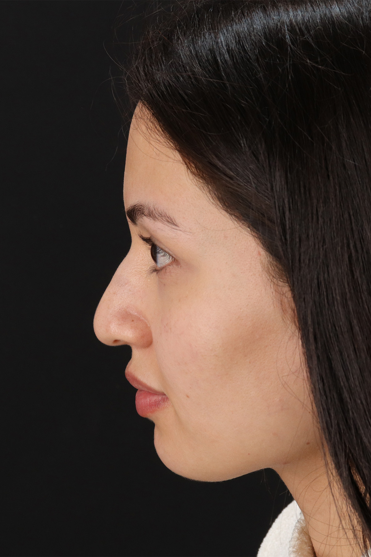 Rhinoplasty Before & After Patient #12282