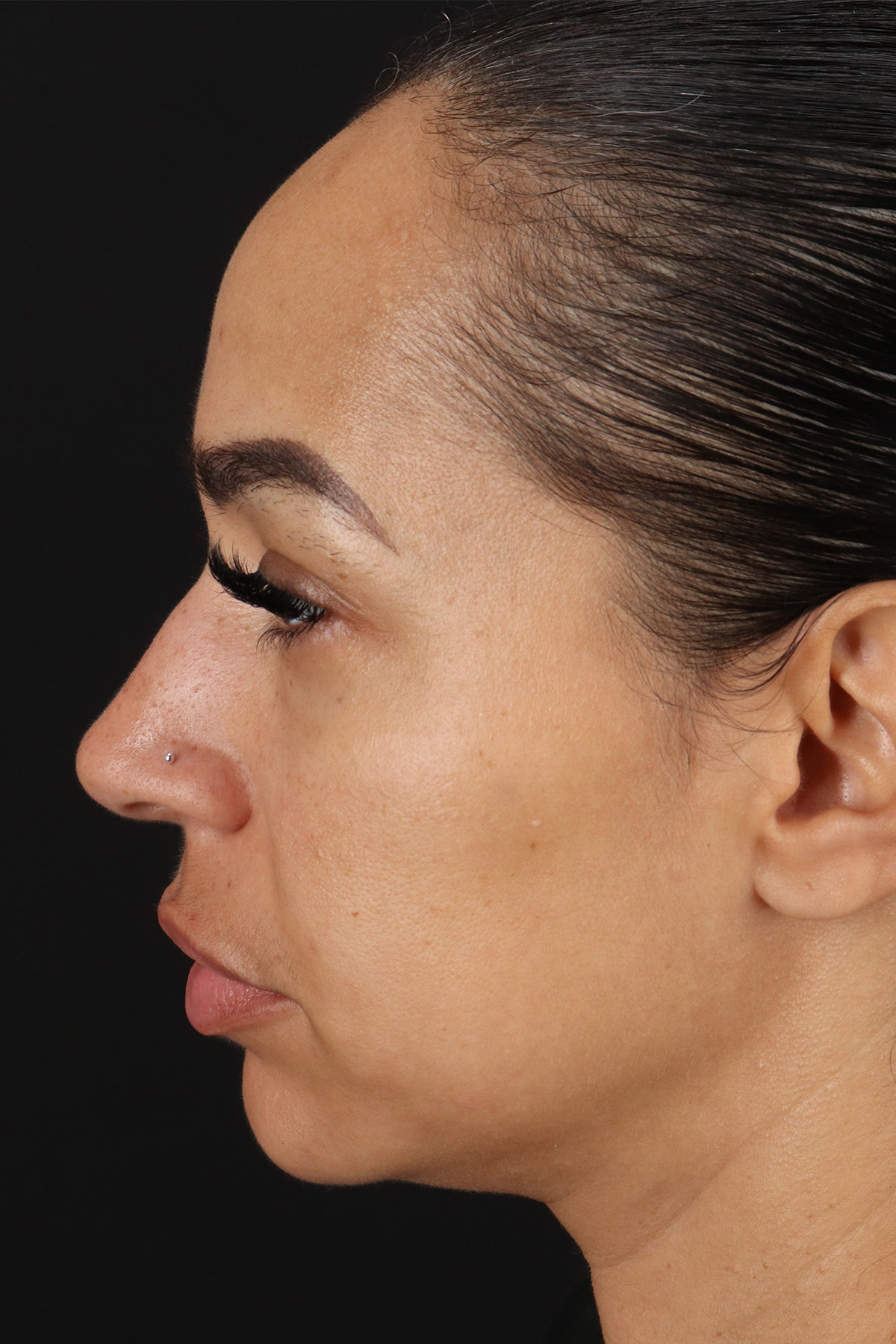 Chin Implant Before & After Patient #11693