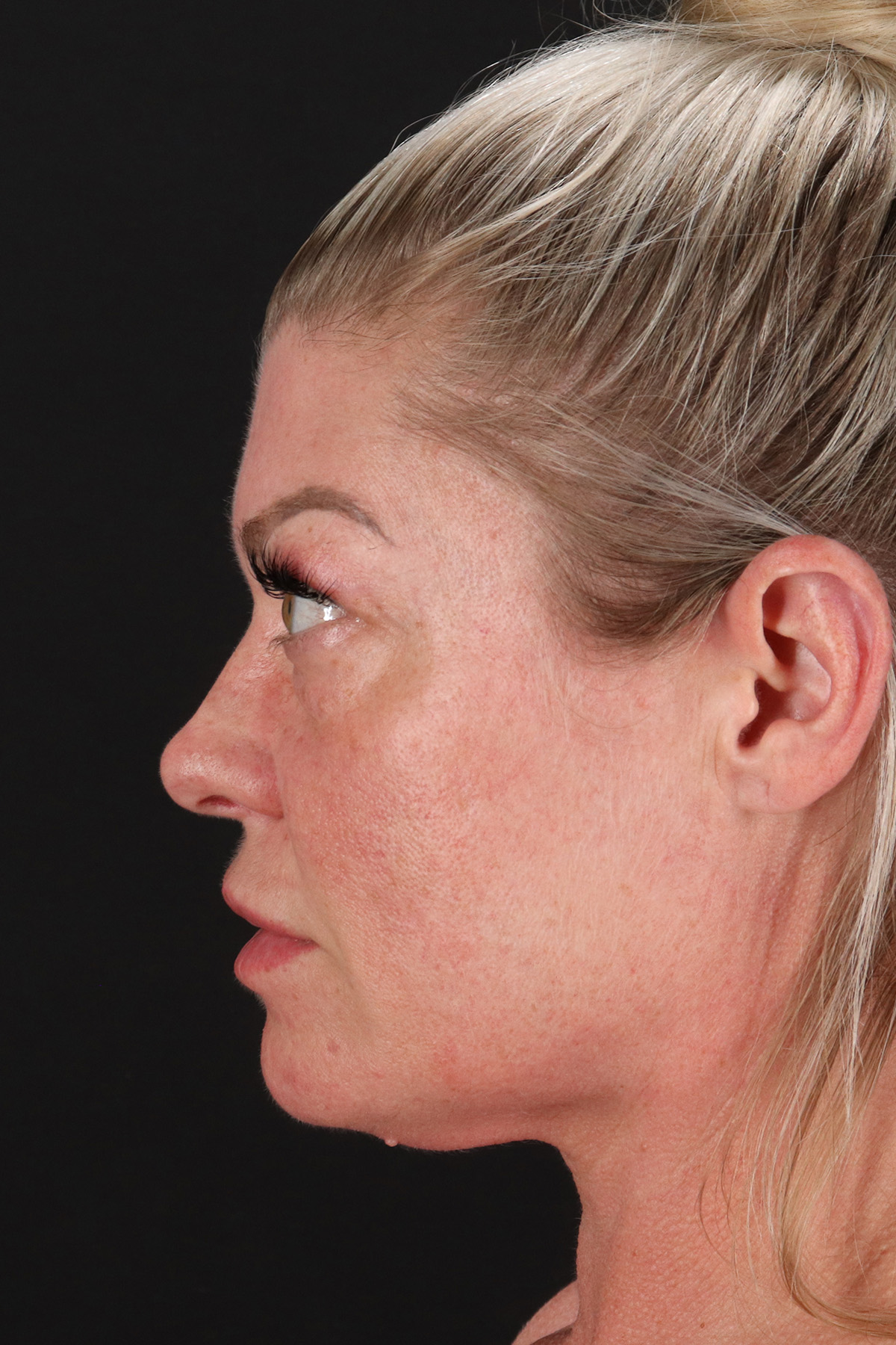 Lower Blepharoplasty Before & After Patient #13030