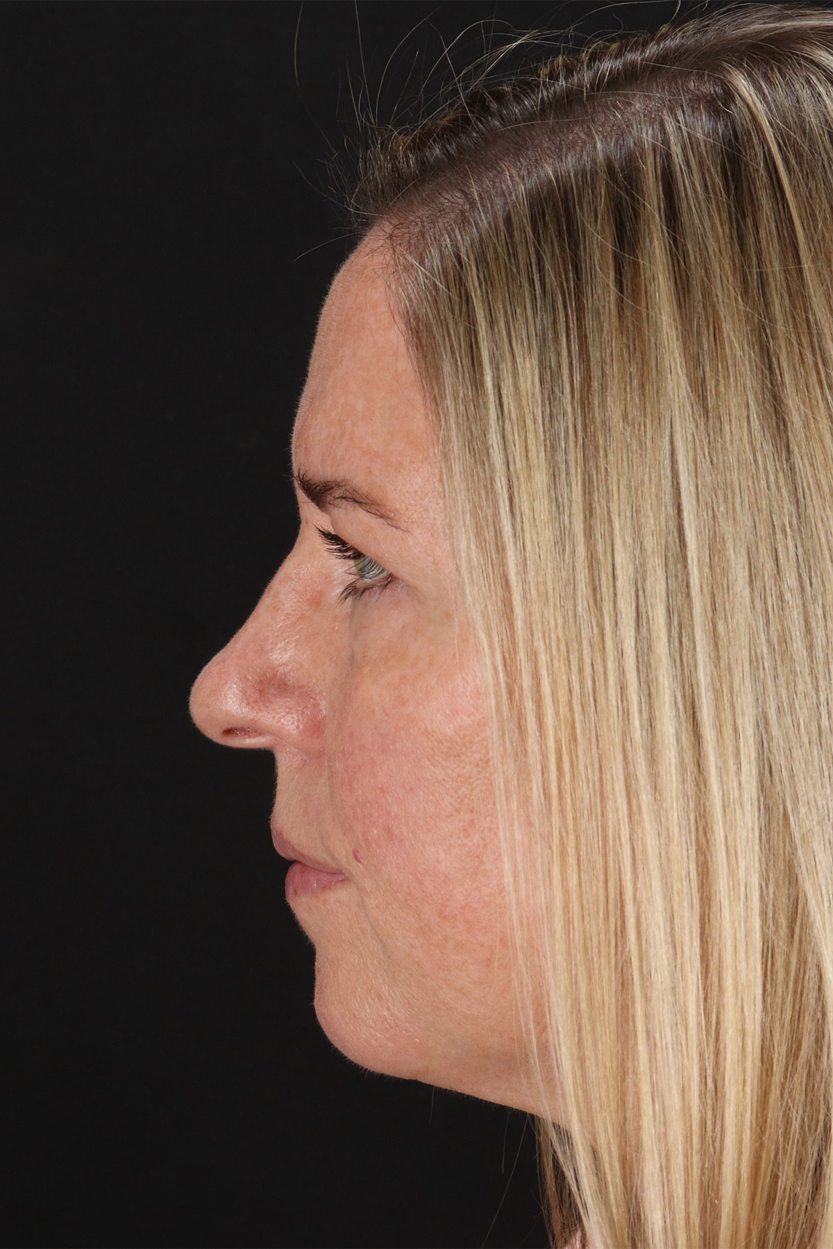 Rhinoplasty Before & After Patient #12194