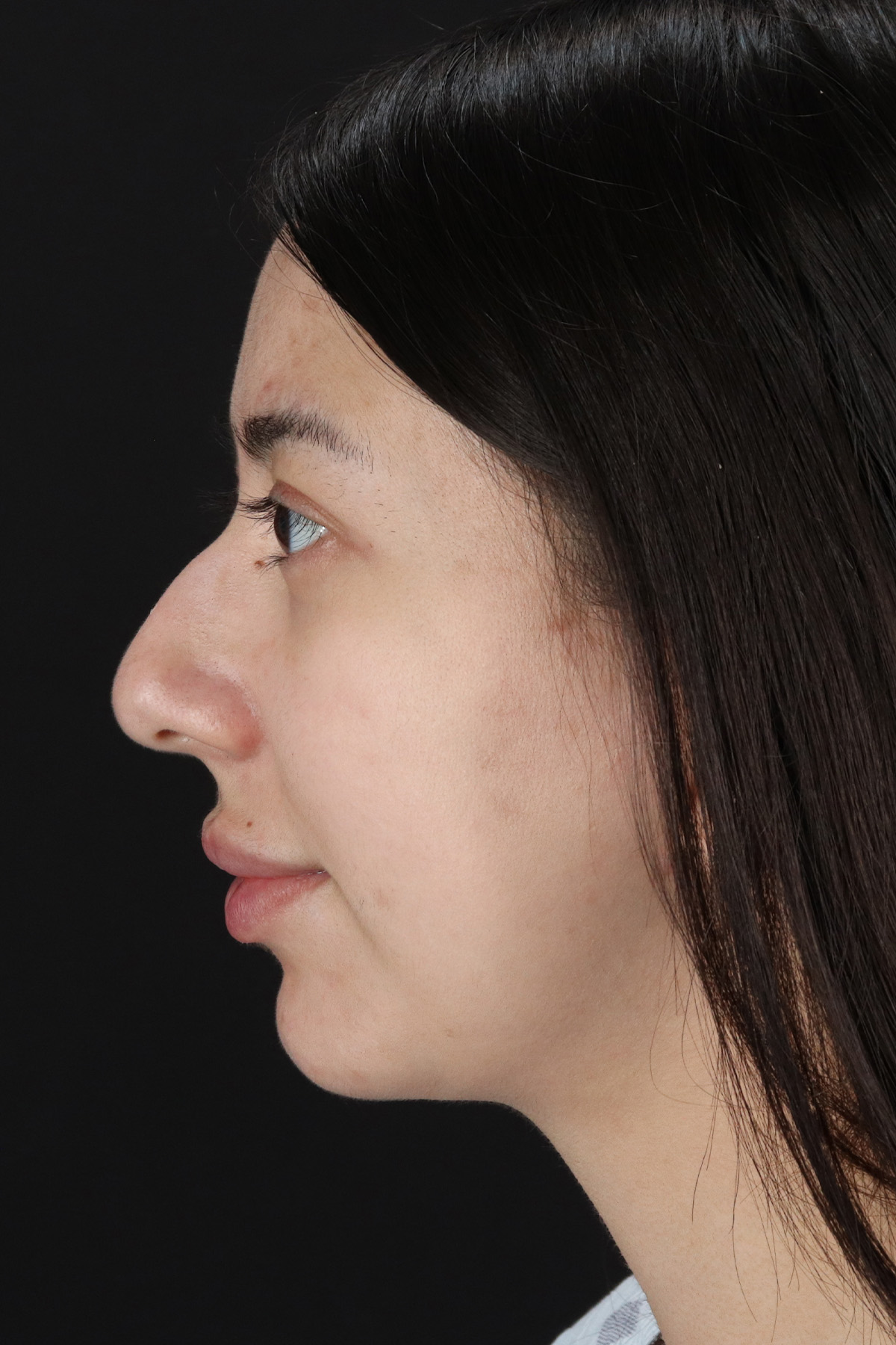 Rhinoplasty Before & After Patient #12359