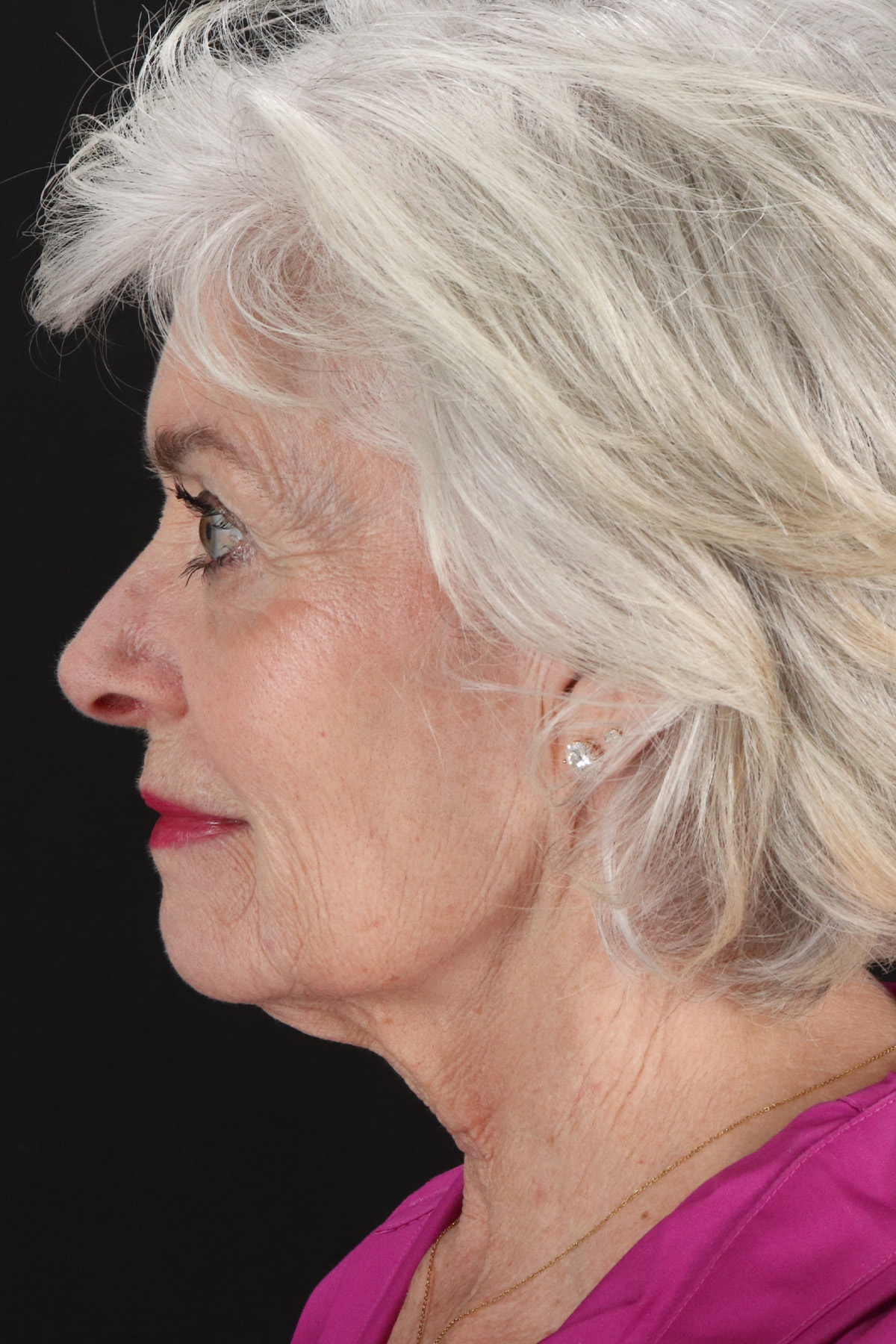Upper Blepharoplasty Before & After Patient #14036