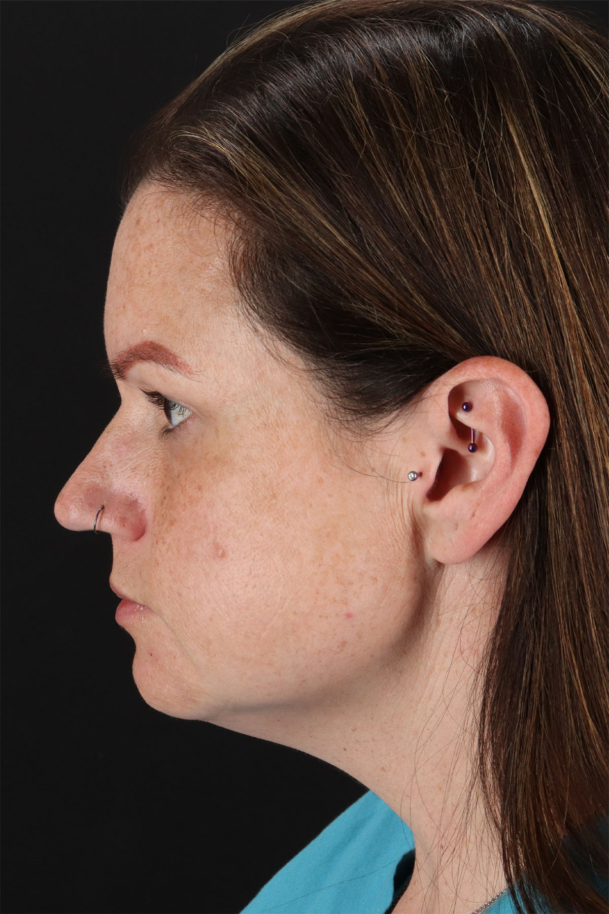 Chemical Peels Before & After Patient #11070