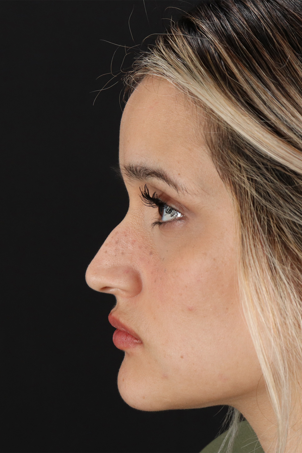 Rhinoplasty Before & After Patient #12260