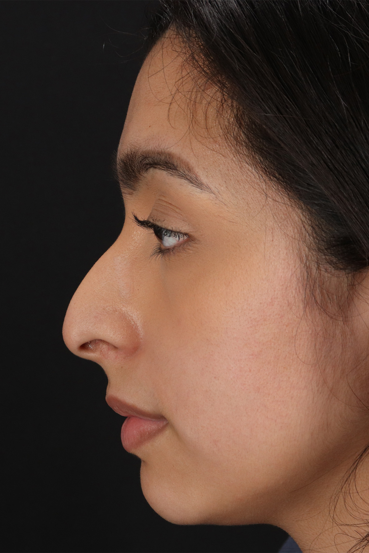 Chin Implant Before & After Patient #13706
