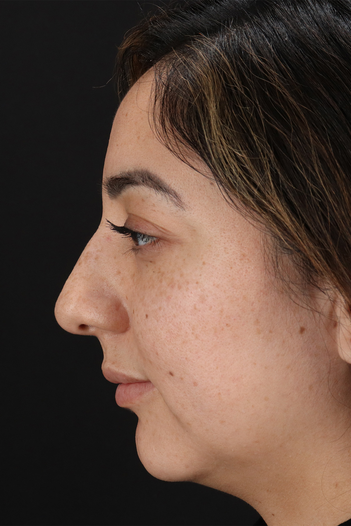Rhinoplasty Before & After Patient #12392