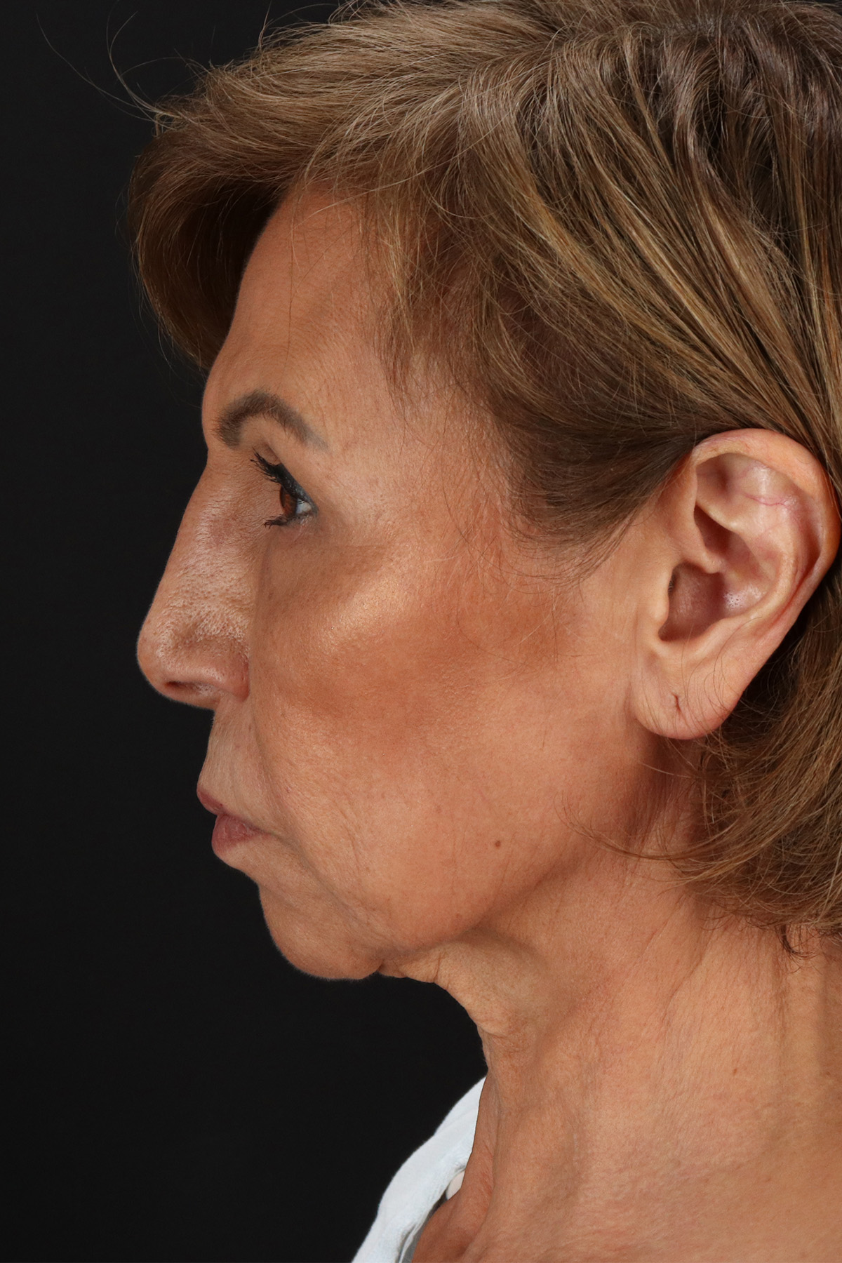 Facelift Before & After Patient #11697