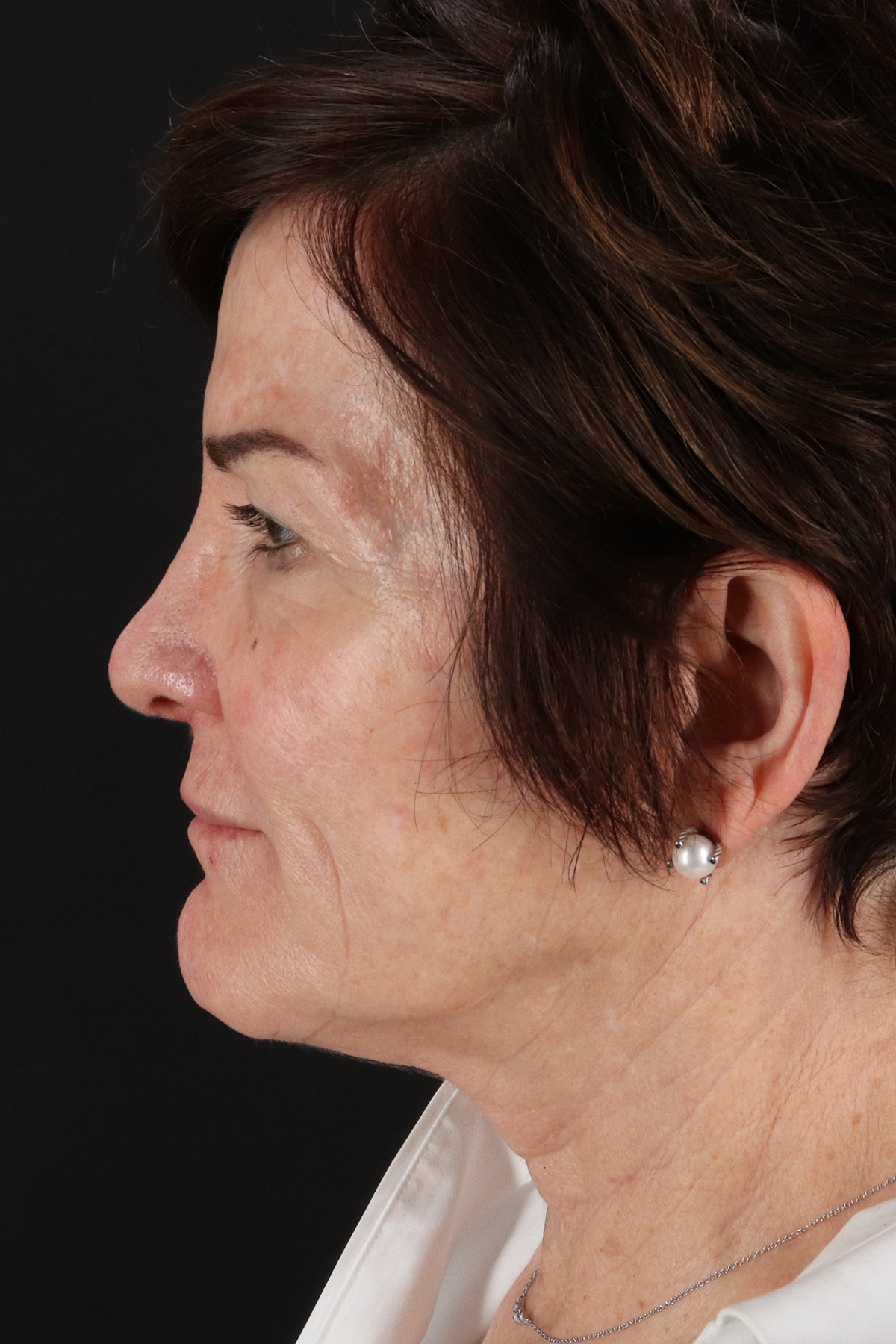 Neck Lift Before & After Patient #10804
