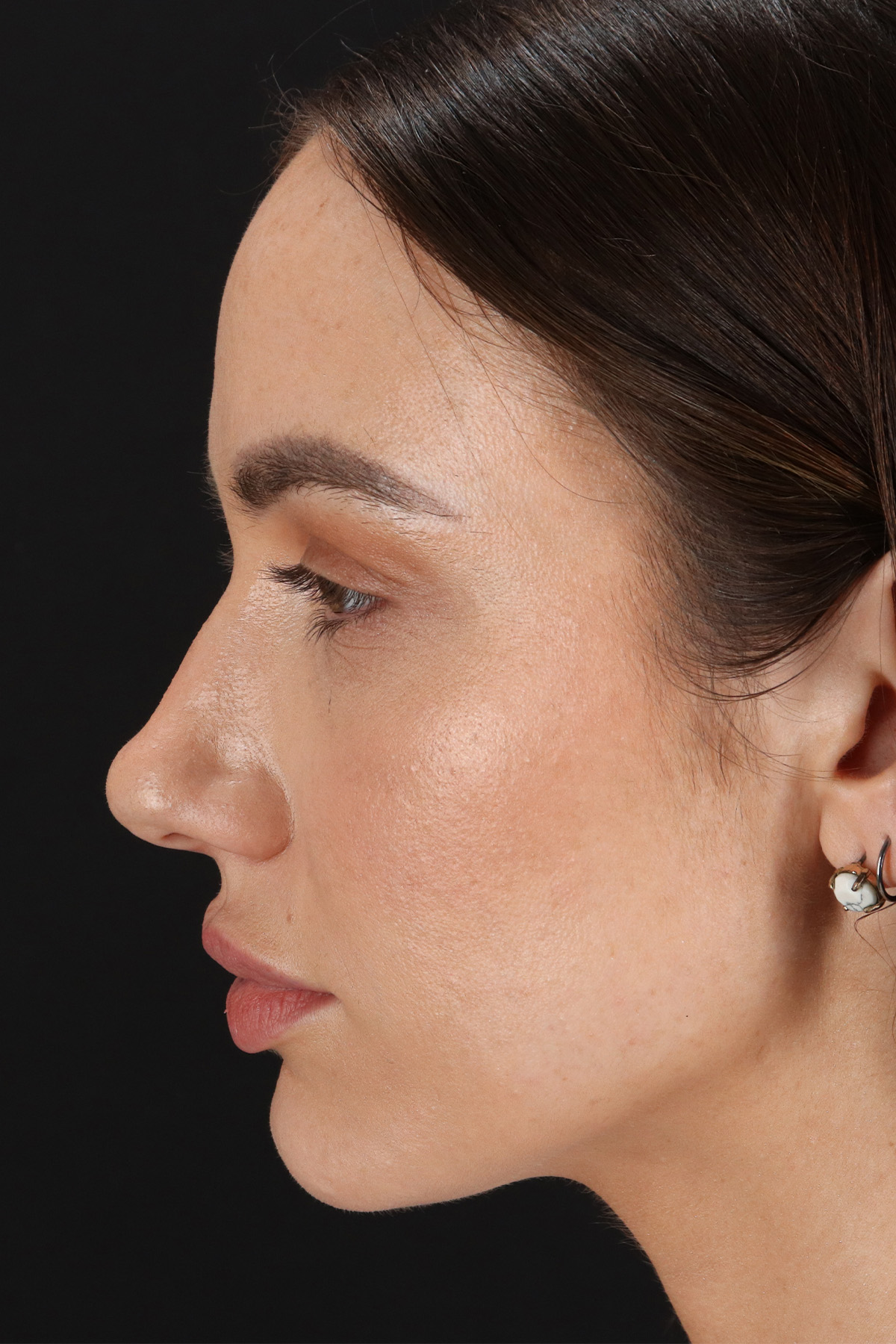 Rhinoplasty Before & After Patient #12370