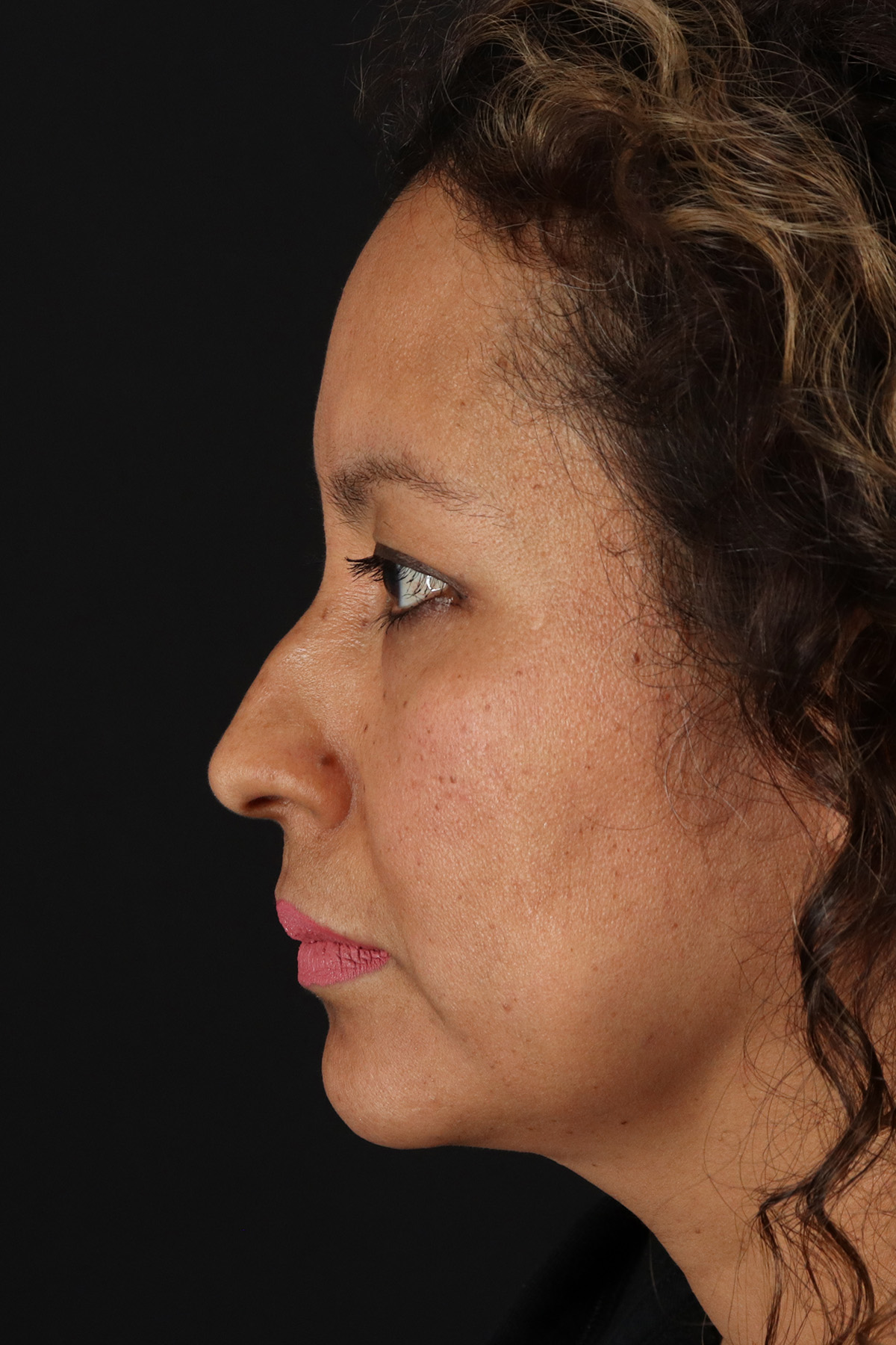 Rhinoplasty Before & After Patient #12293