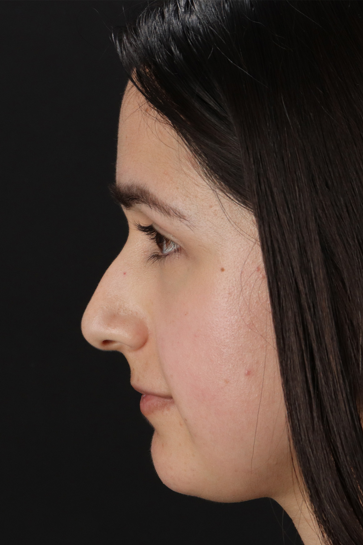 Liquid Rhinoplasty Before & After Patient #11339