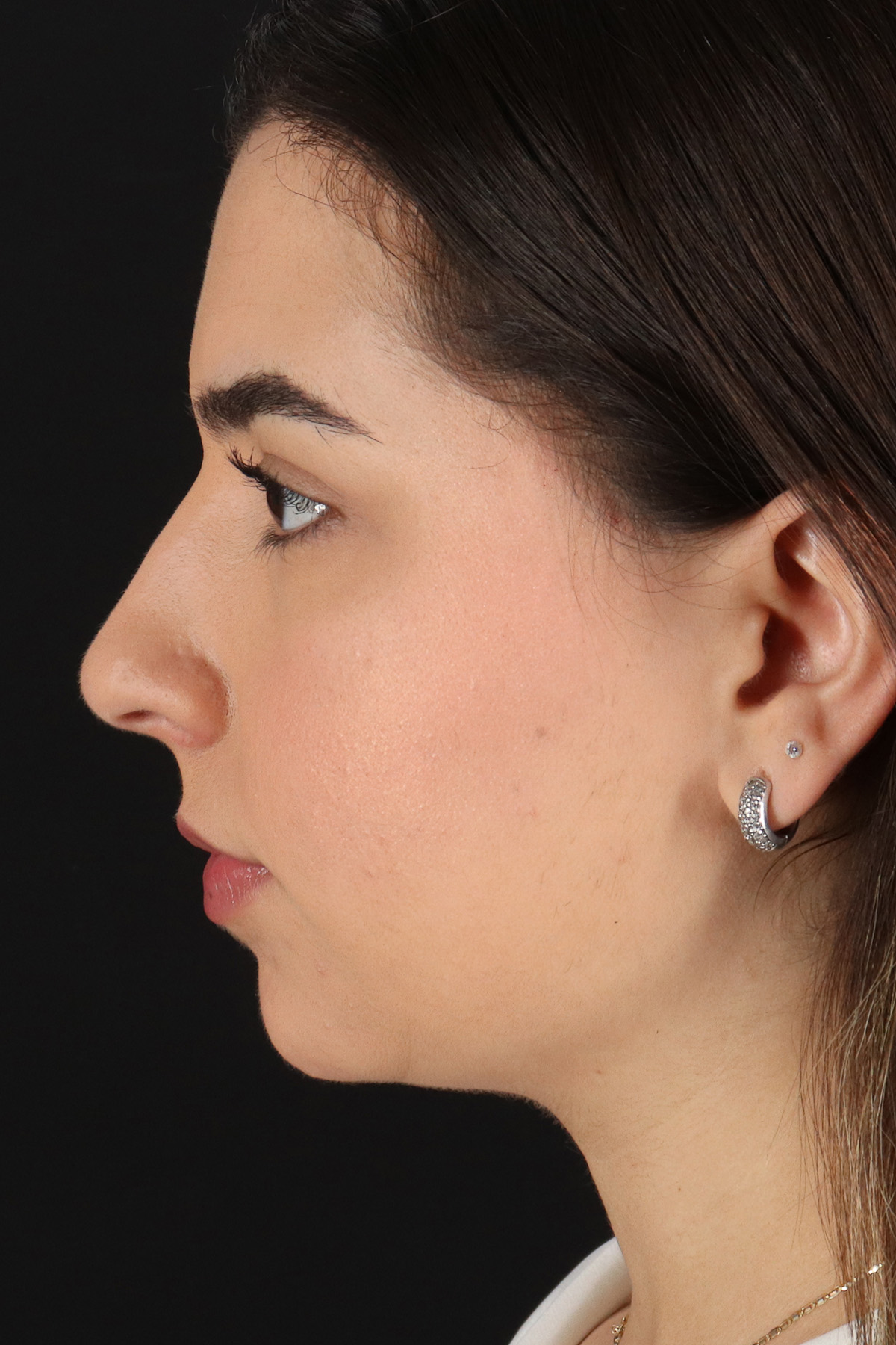 Chin Implant Before & After Patient #11694