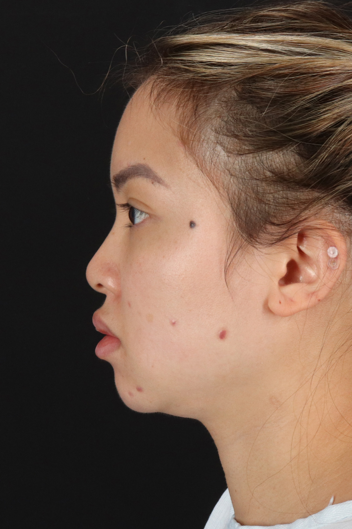 Chin Implant Before & After Patient #13816
