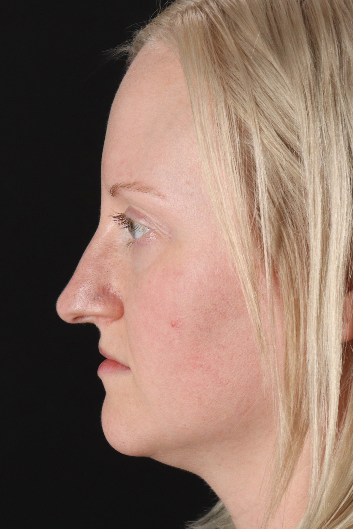Rhinoplasty Before & After Patient #12381