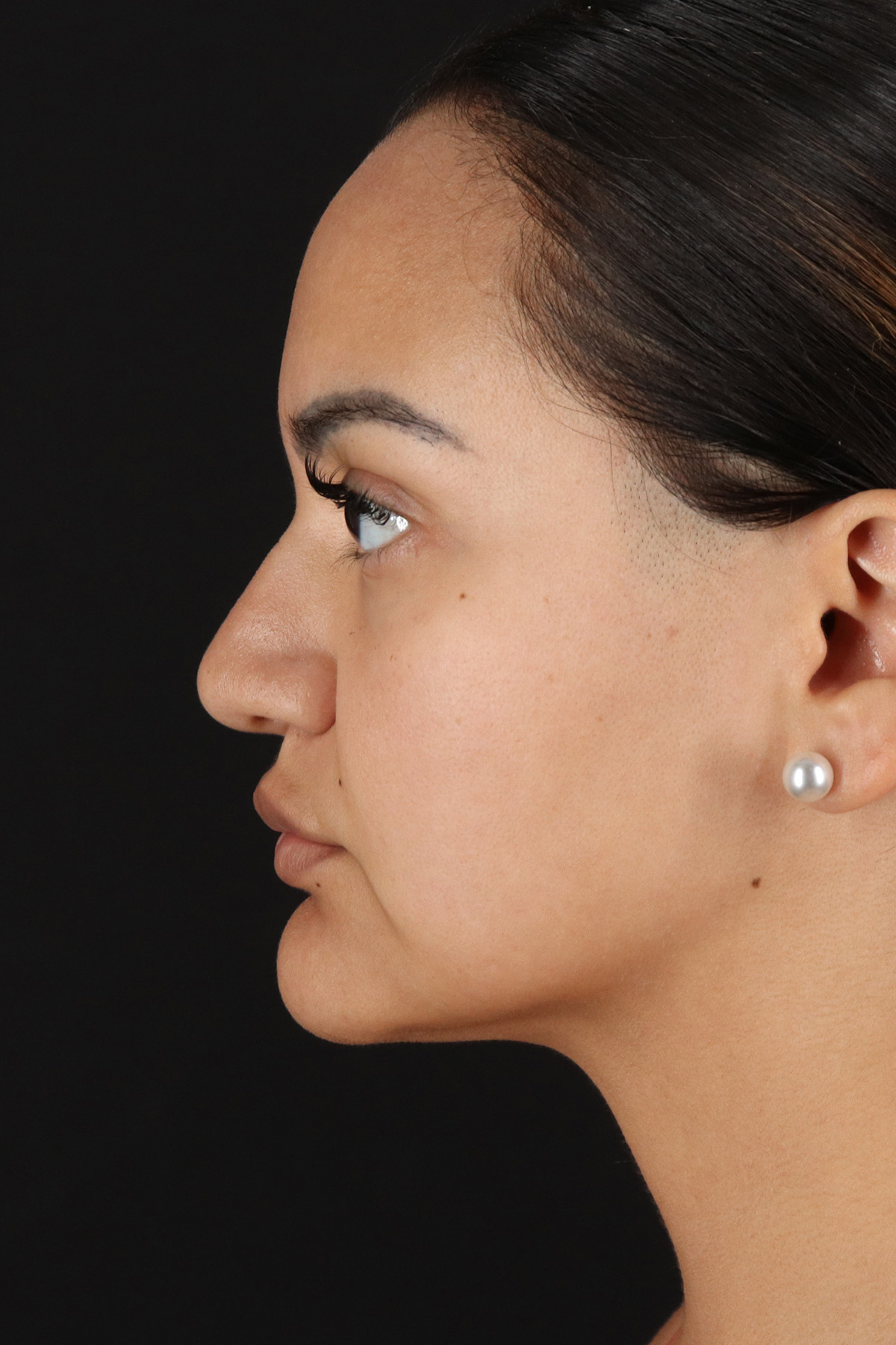Rhinoplasty Before & After Patient #12326