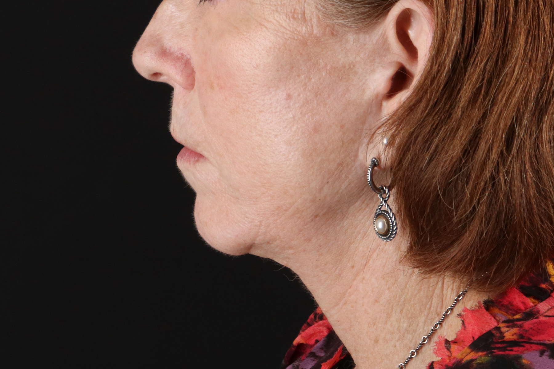 Neck Liposuction Before & After Patient #12117