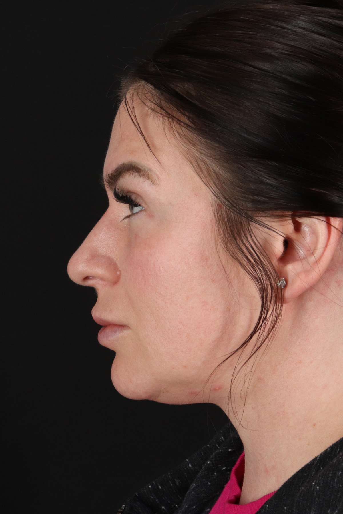 Rhinoplasty Before & After Patient #12414