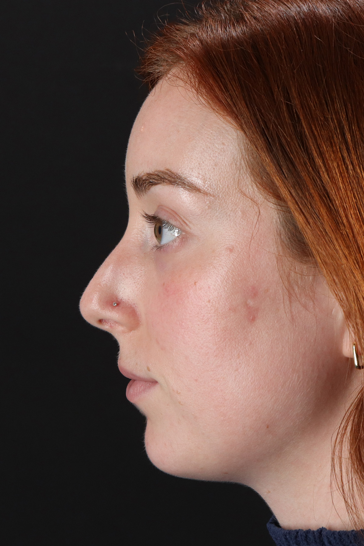 Rhinoplasty Before & After Patient #12348