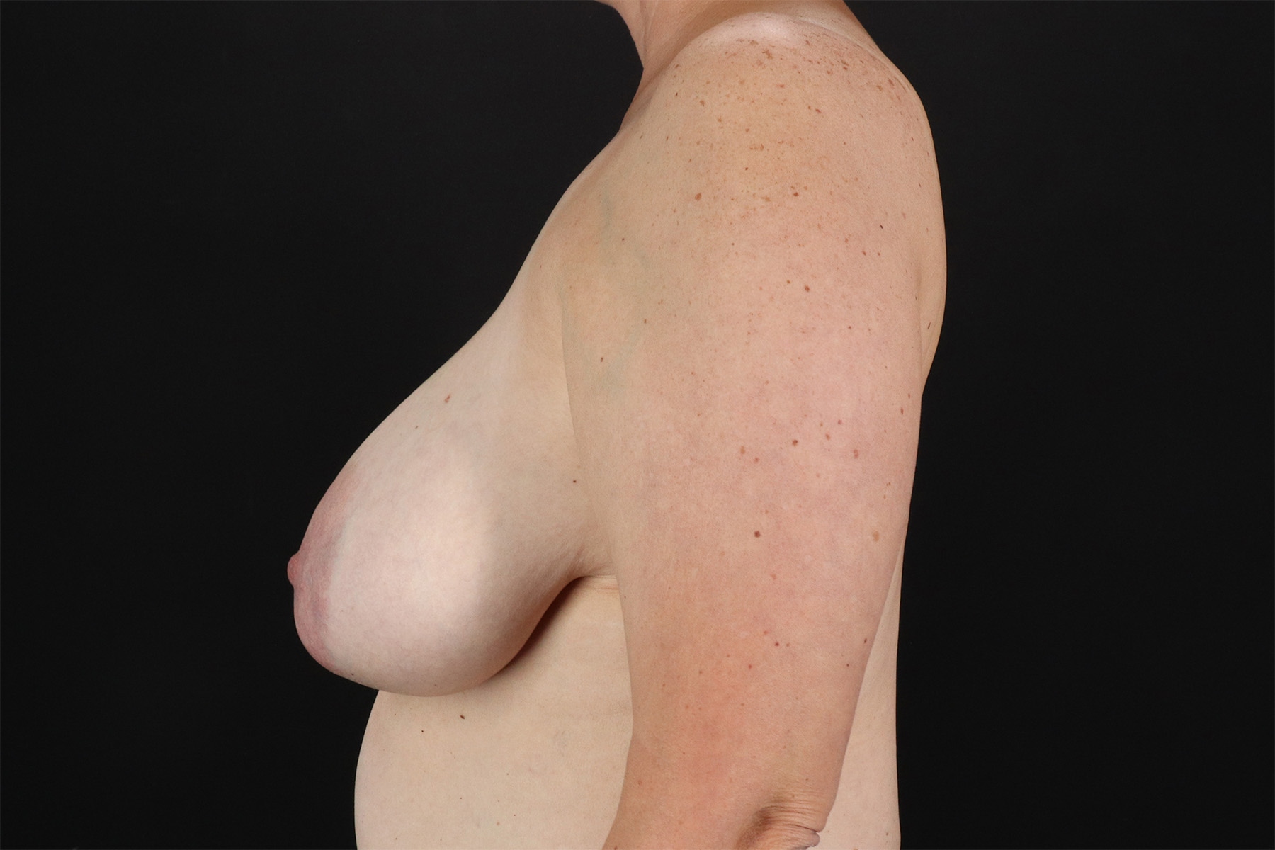 Breast Lift Before & After Patient #11092