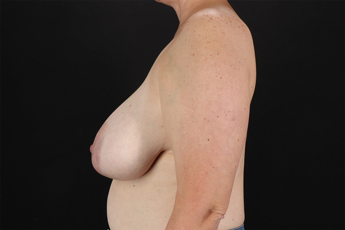 Breast Reduction With Lift Before & After Patient #10969