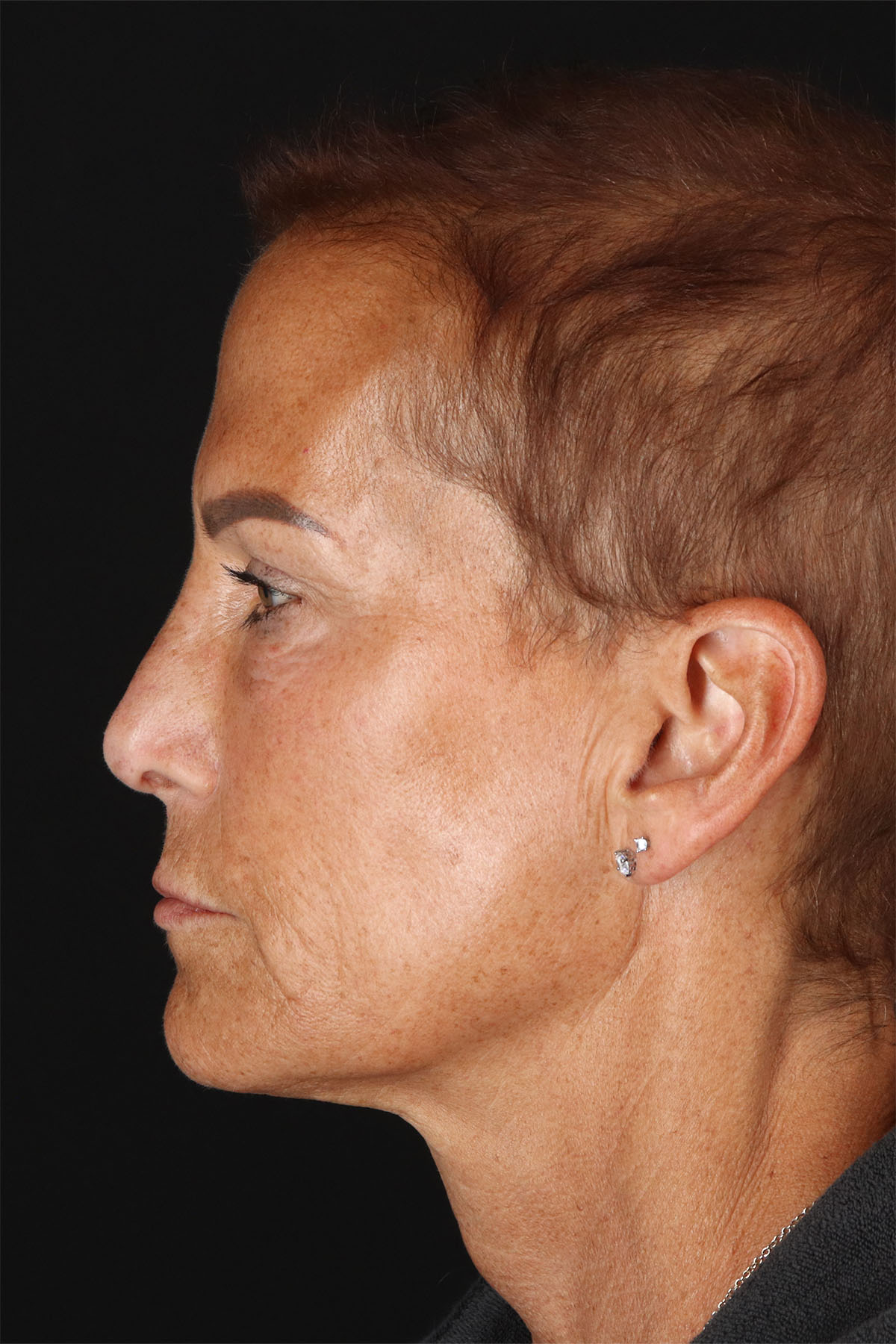 CO2 Laser Before & After Patient #10980