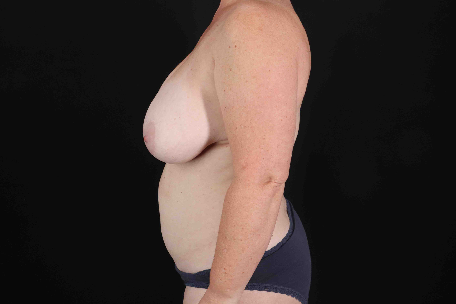 Mommy Makeover Before & After Patient #11938