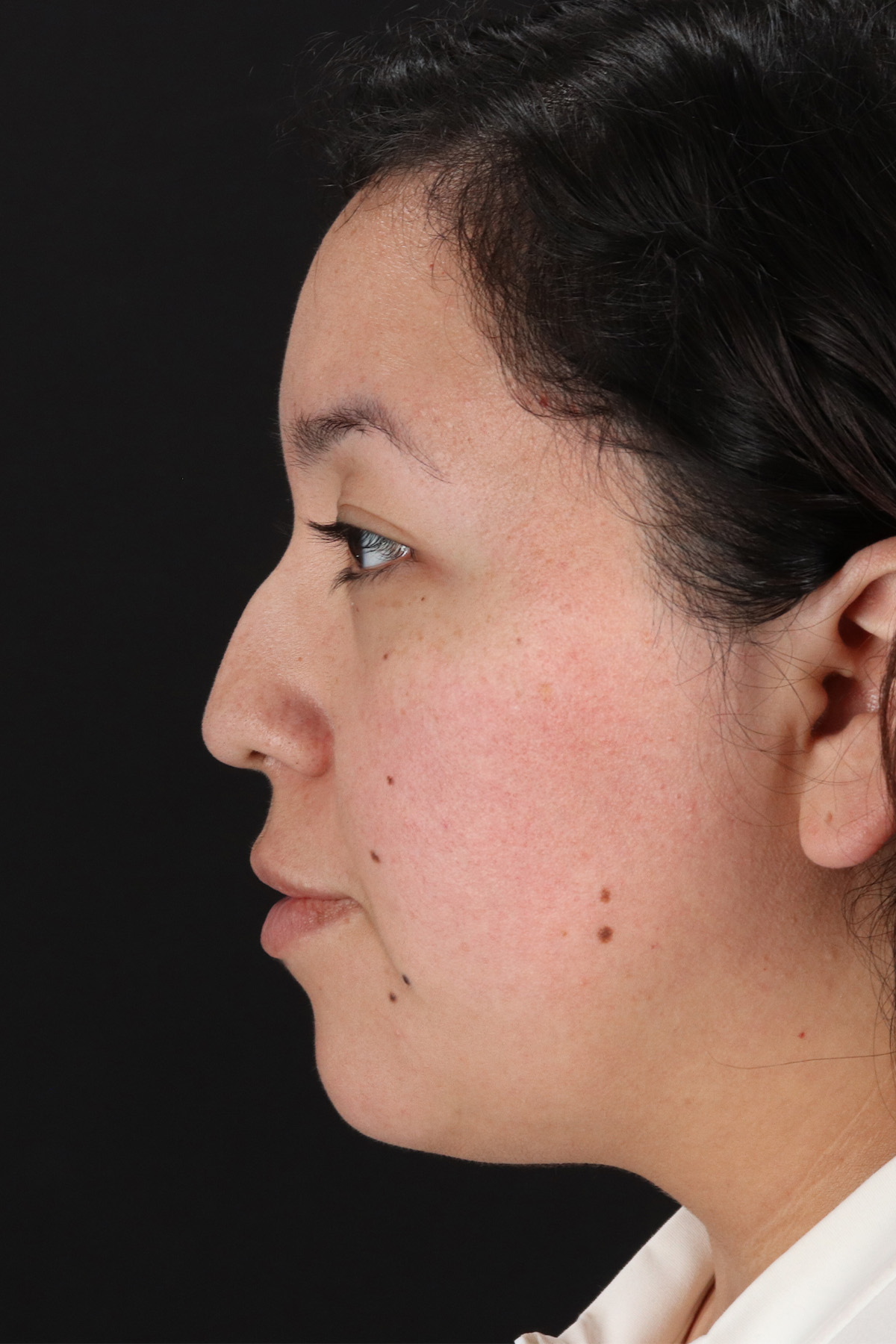 Rhinoplasty Before & After Patient #12447