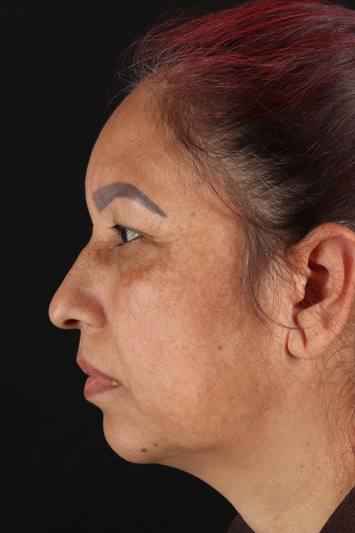 Upper Blepharoplasty Before & After Patient #12051