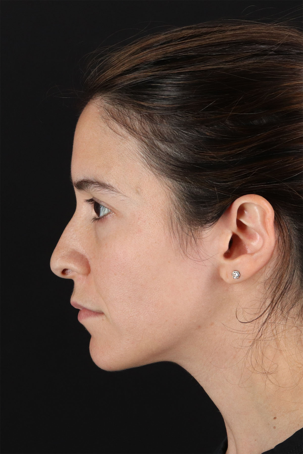 CO2 Laser Before & After Patient #11103