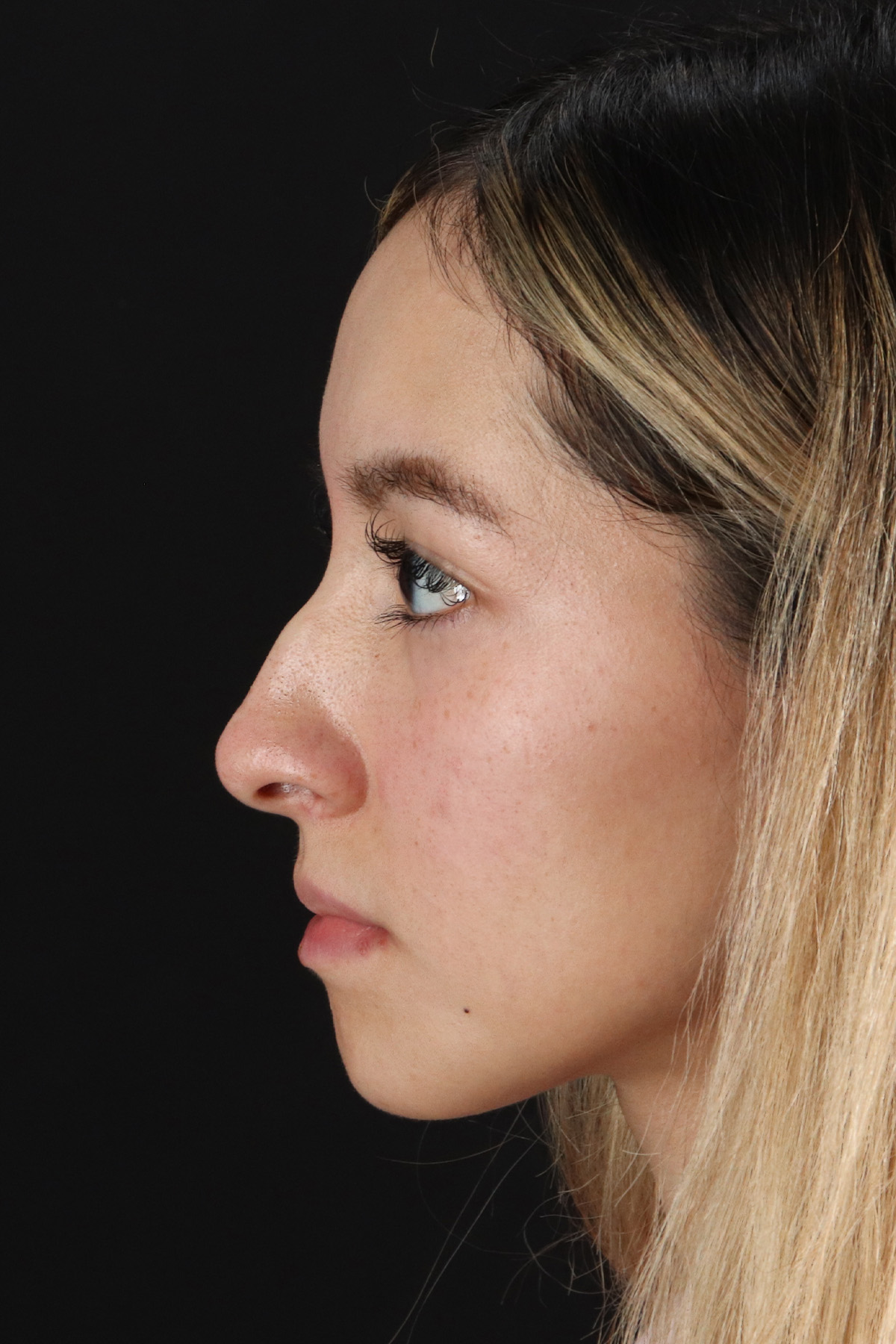 Rhinoplasty Before & After Patient #12216