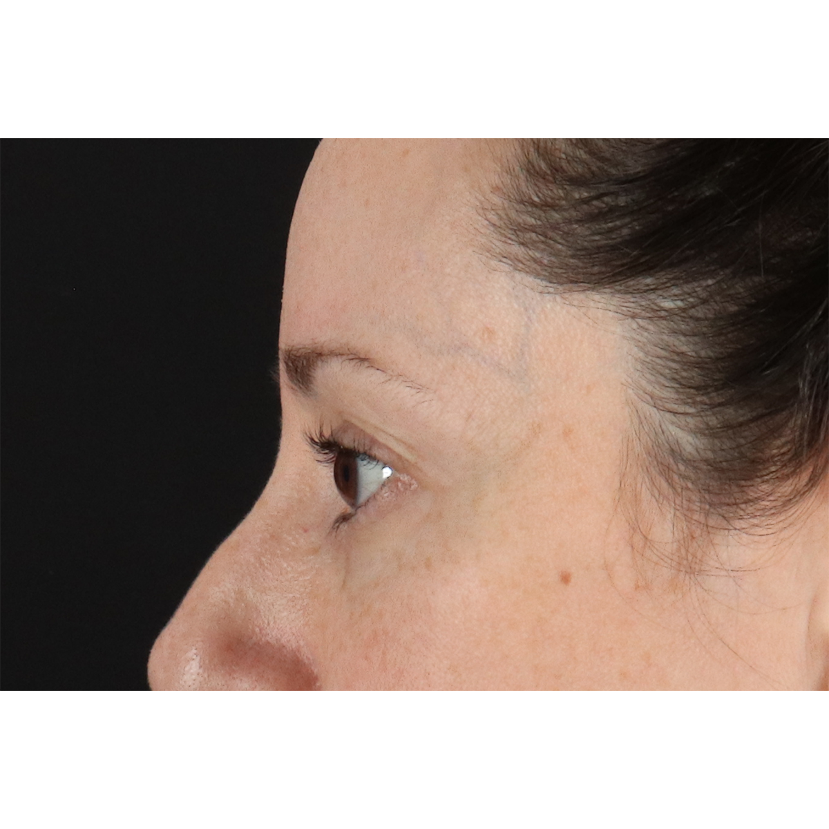 Blepharoplasty (Eyelid Surgery) Before & After Patient #11114