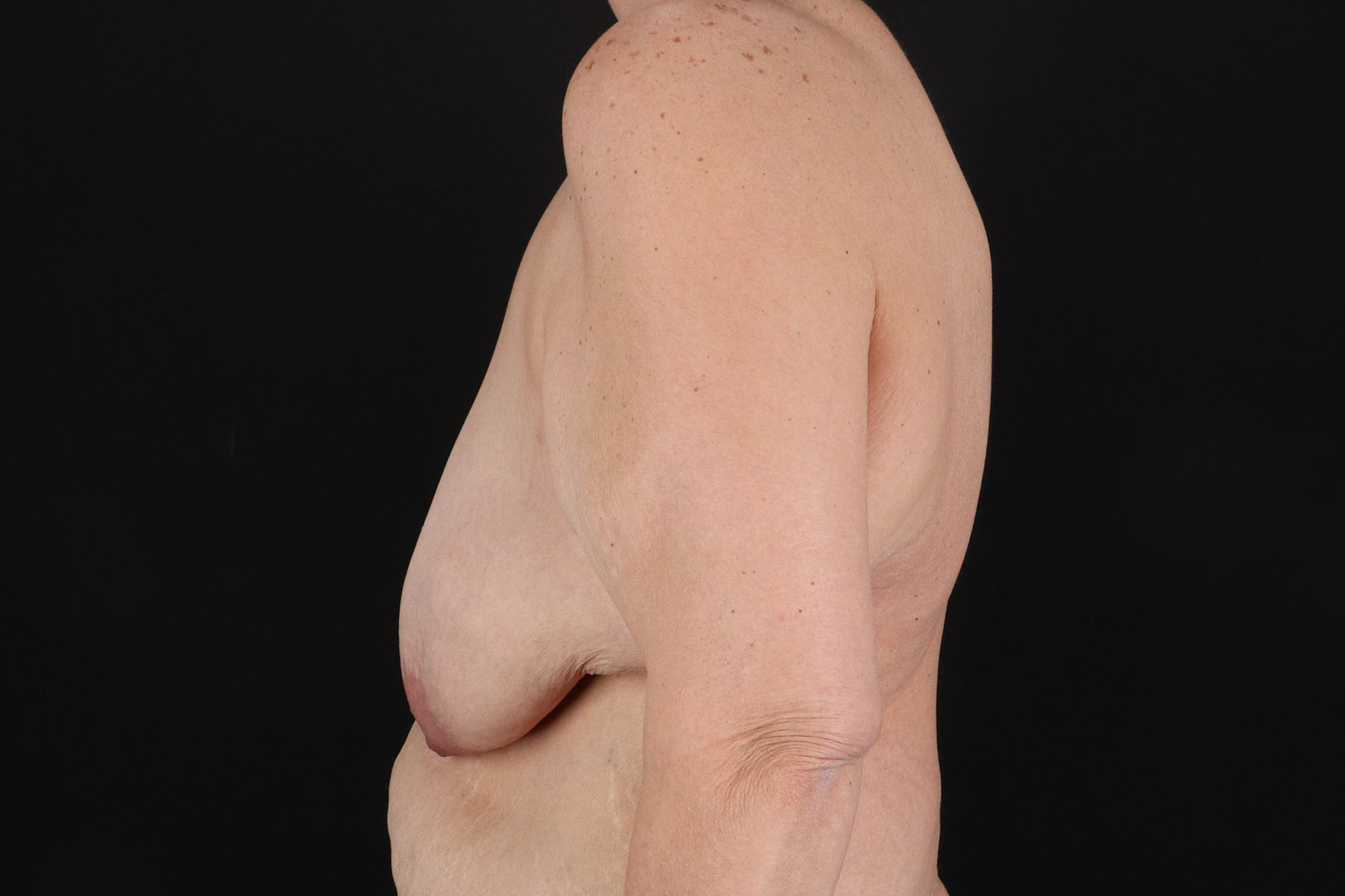 Breast Reduction With Lift Before & After Patient #10925
