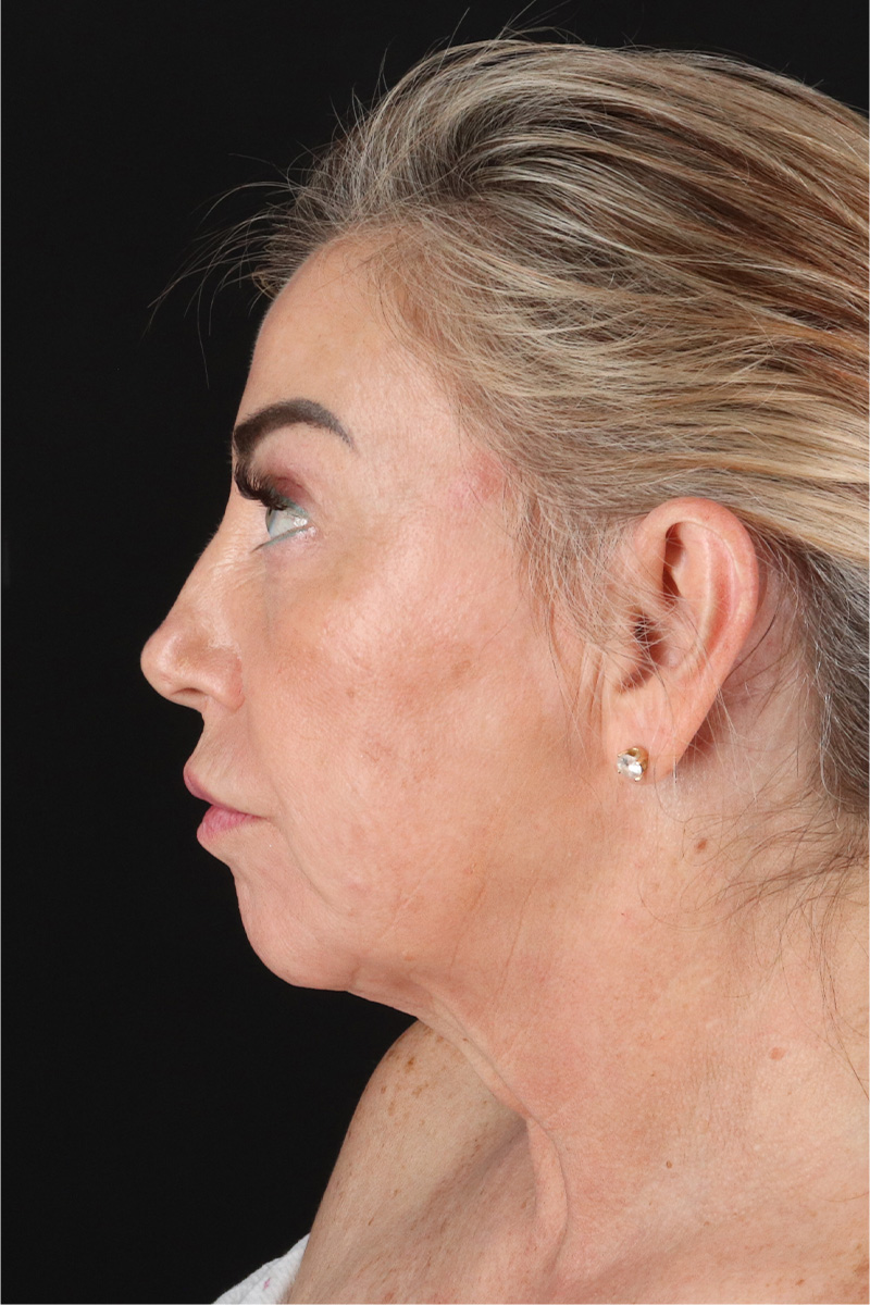 Facelift Before & After Patient #11462