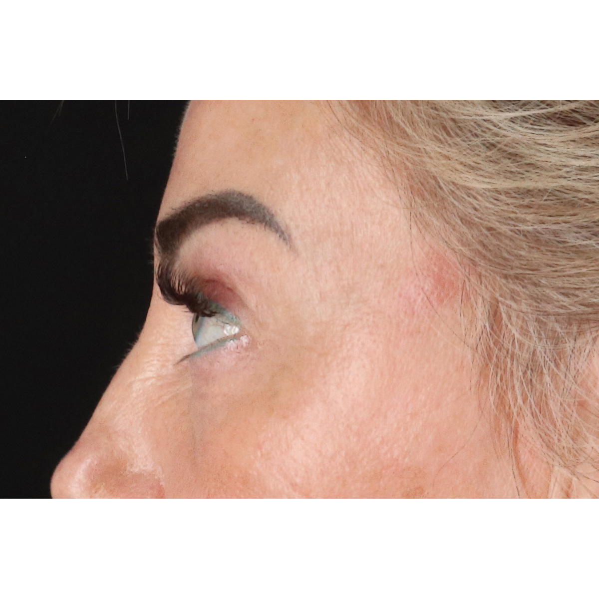 Blepharoplasty (Eyelid Surgery) Before & After Patient #11506