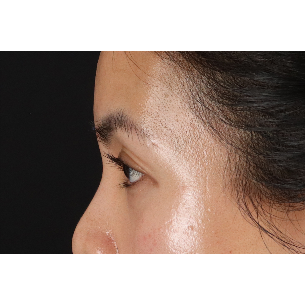 Blepharoplasty (Eyelid Surgery) Before & After Patient #10782