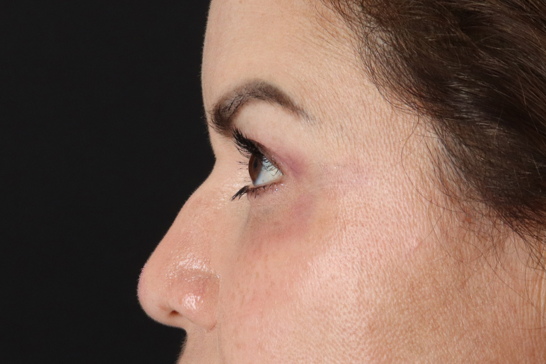 Rhinoplasty Before & After Patient #12656