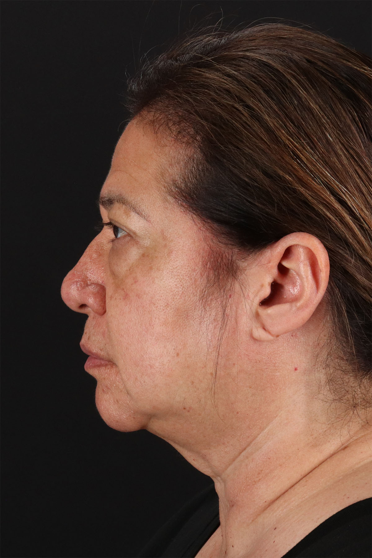 CO2 Laser Before & After Patient #11136