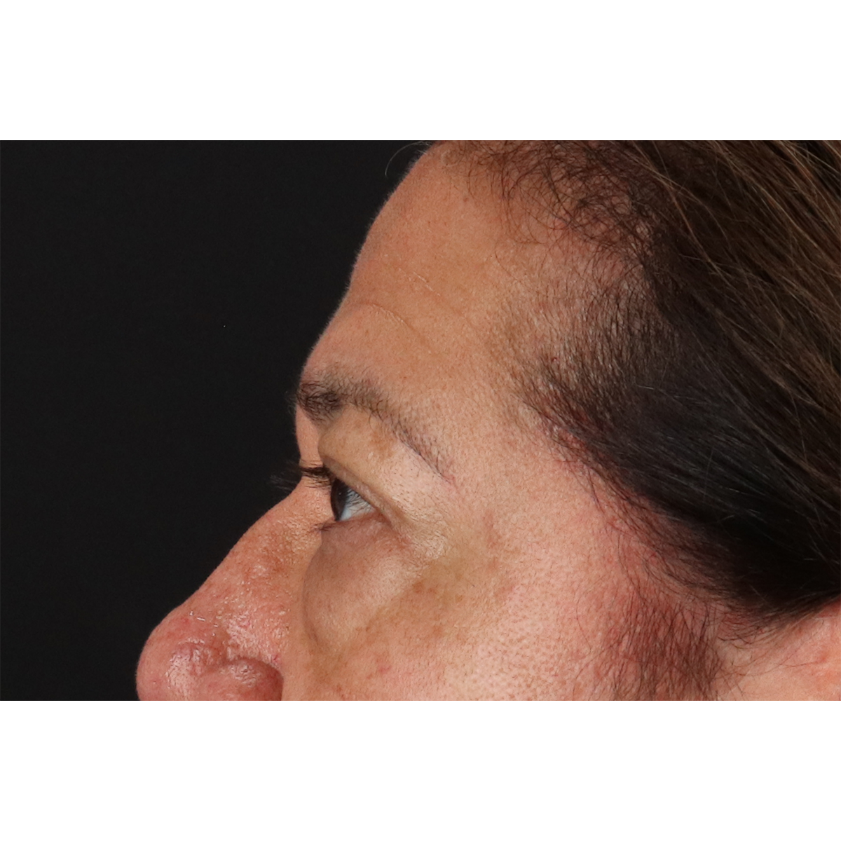 Blepharoplasty (Eyelid Surgery) Before & After Patient #11125