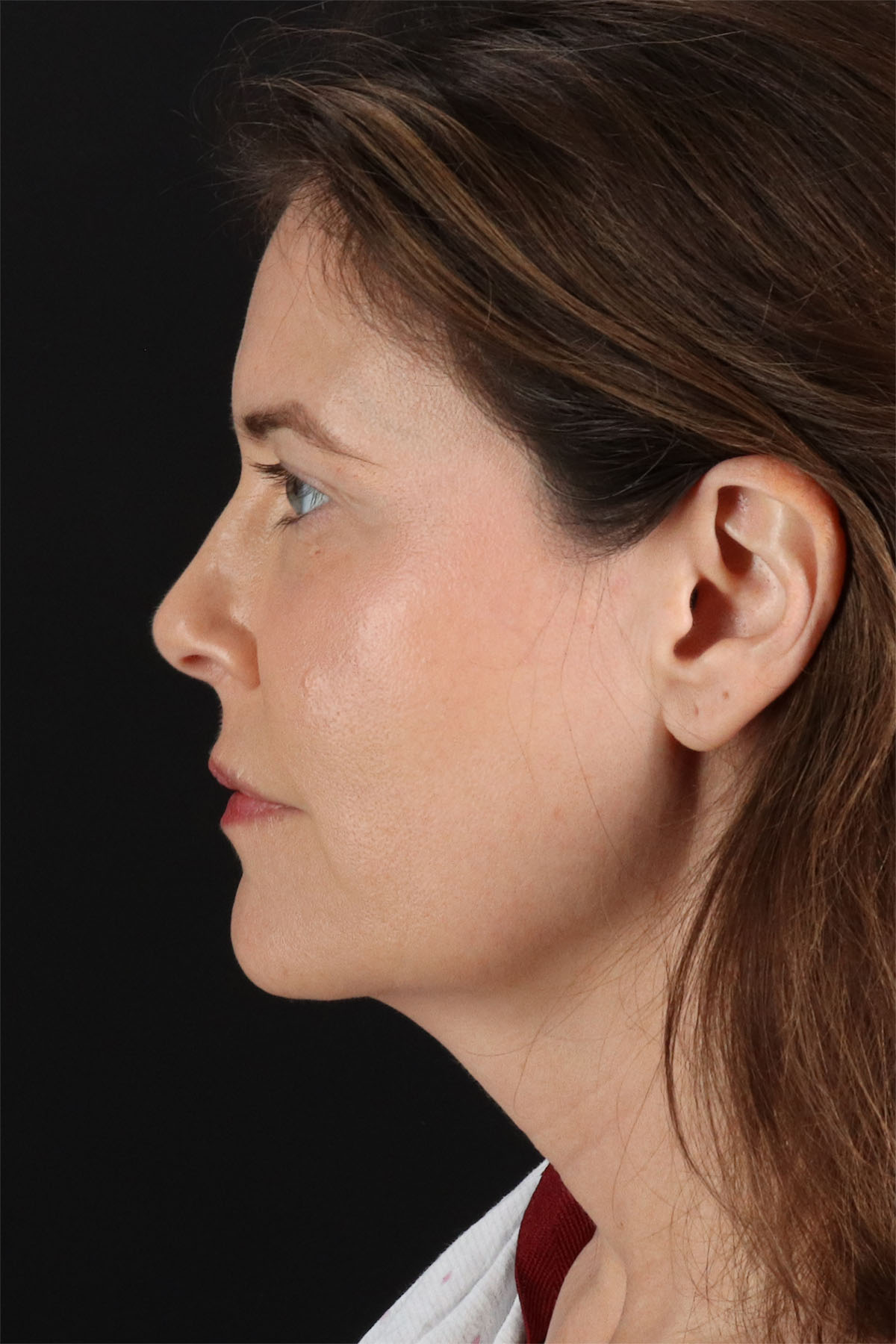 Fat Grafting To The Face Before & After Patient #11817