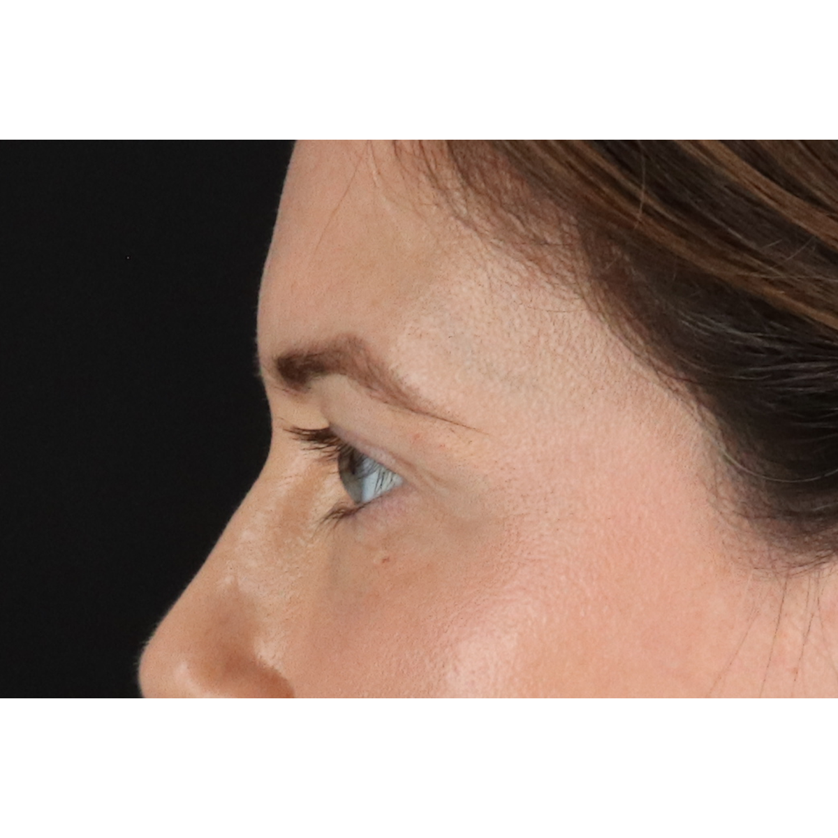Blepharoplasty (Eyelid Surgery) Before & After Patient #11517