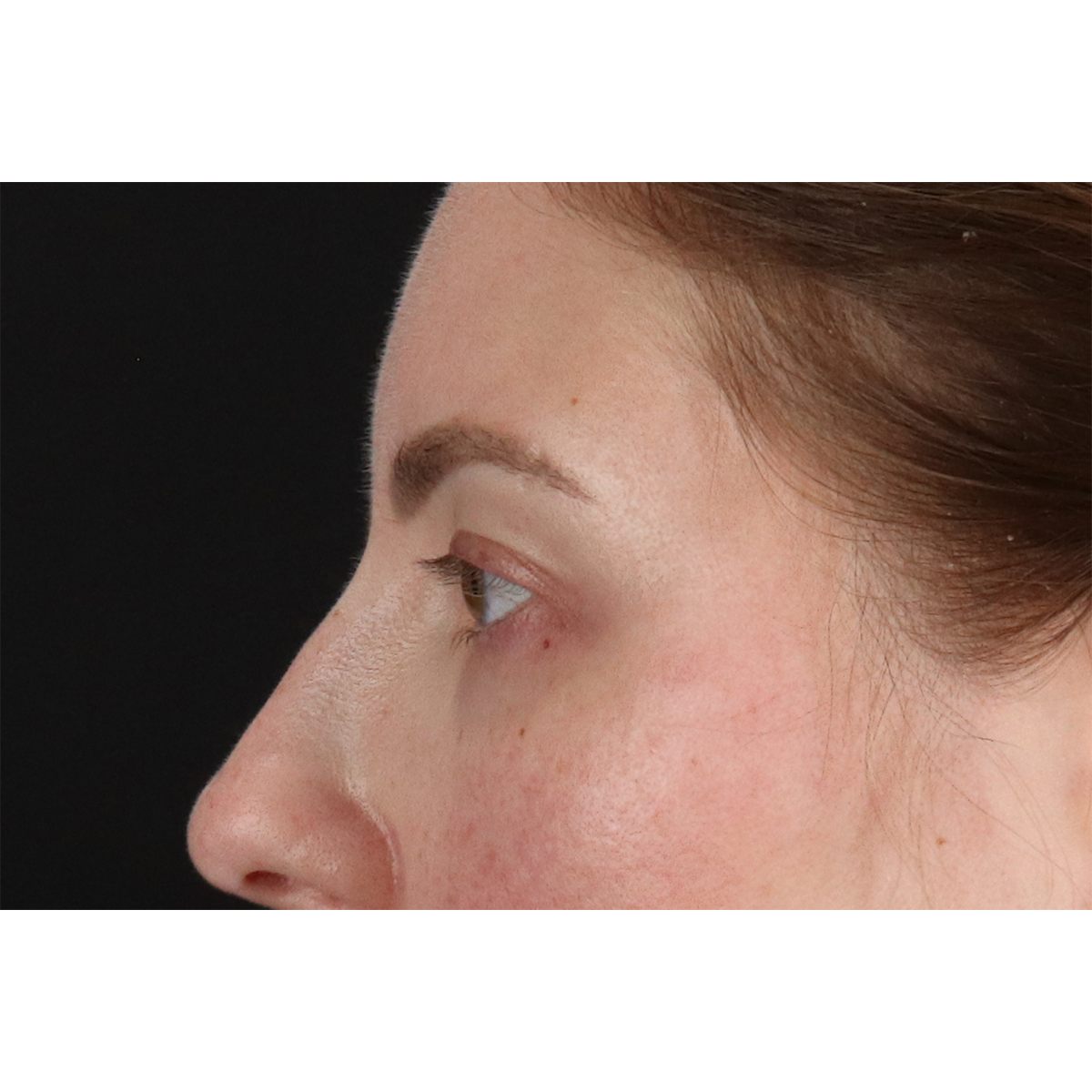 Brow Lift Before & After Patient #11657