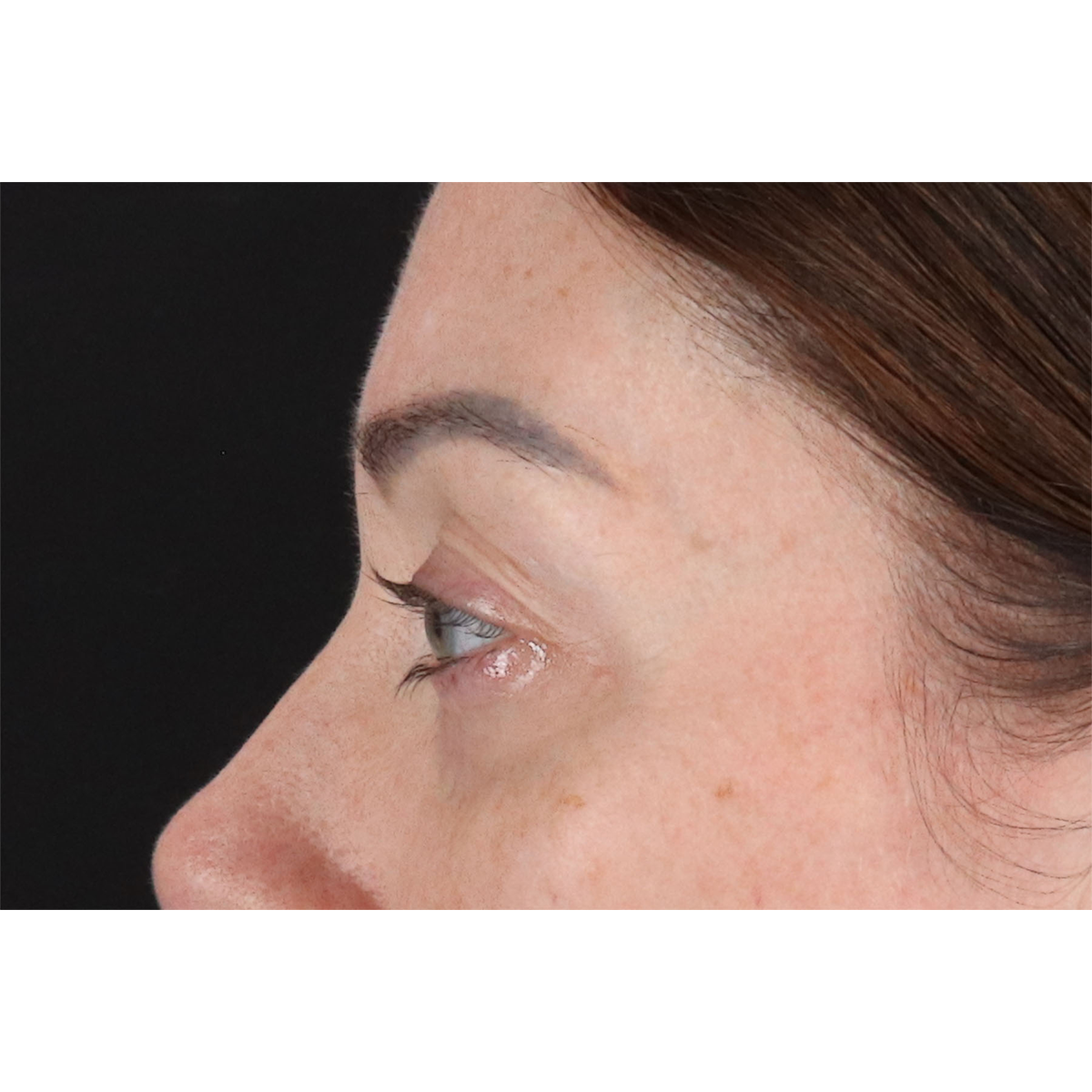 Blepharoplasty (Eyelid Surgery) Before & After Patient #11026