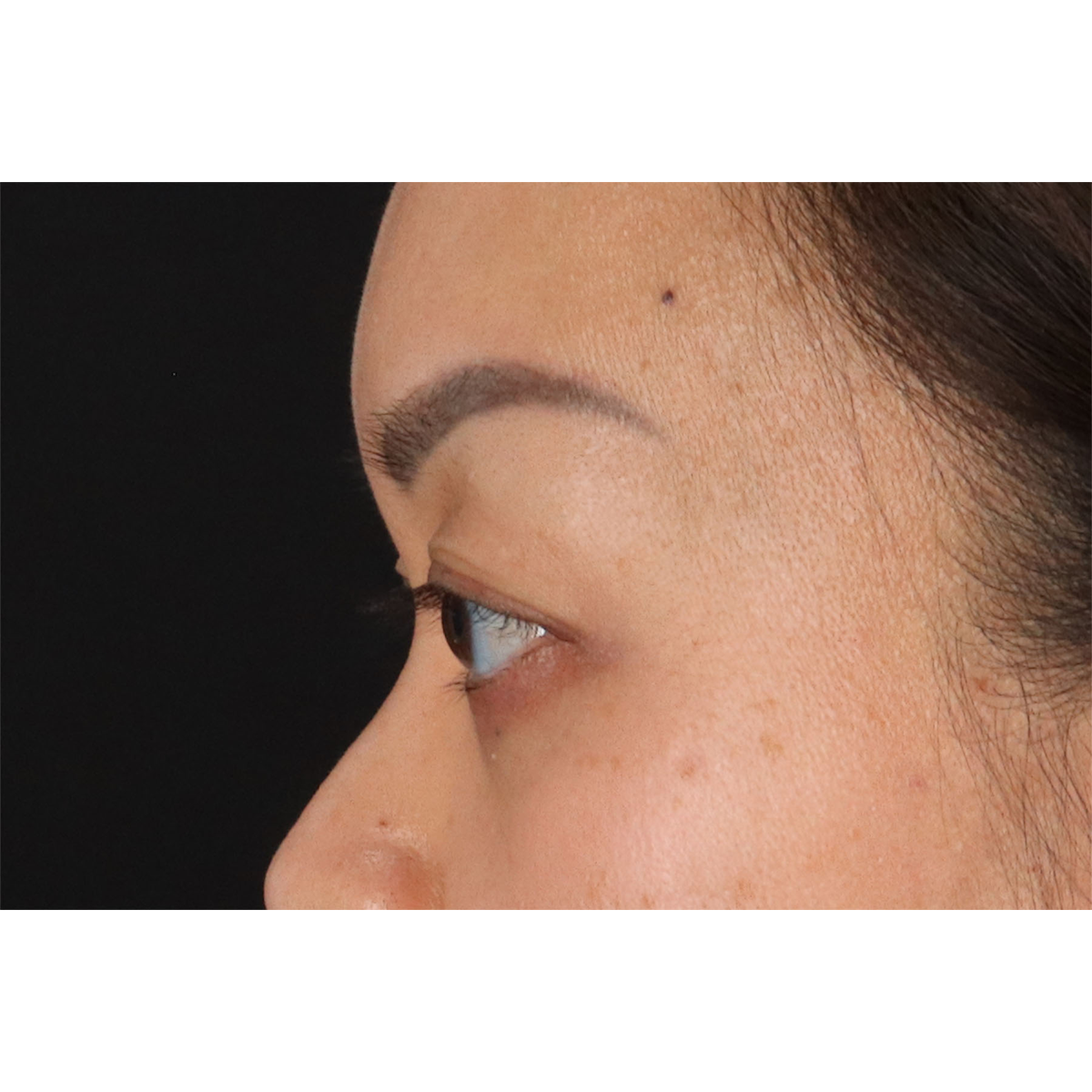 Blepharoplasty (Eyelid Surgery) Before & After Patient #11037