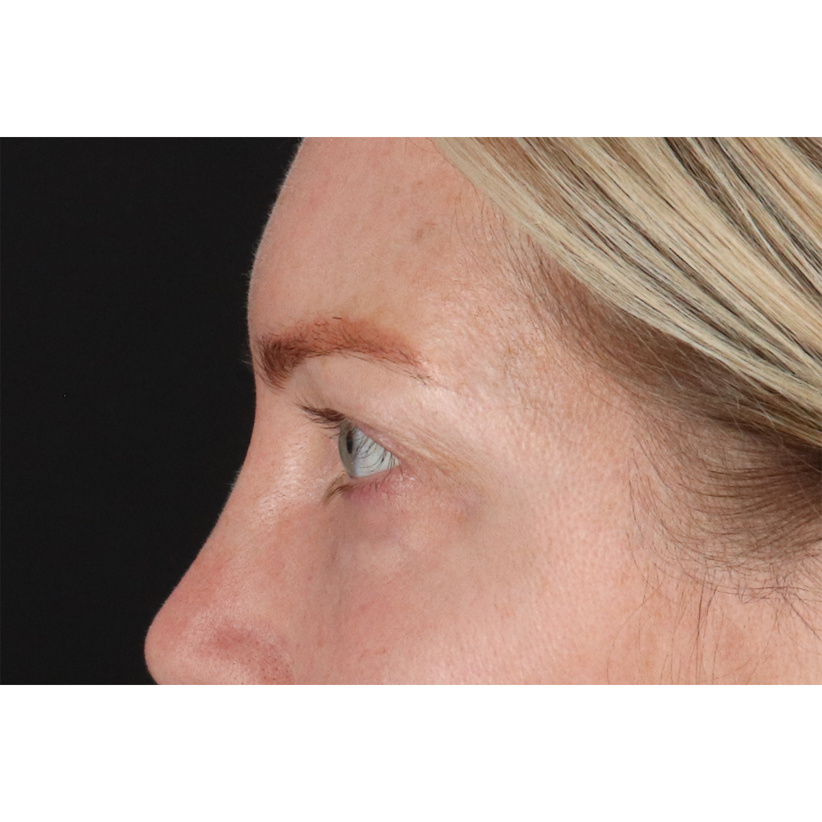 Blepharoplasty (Eyelid Surgery) Before & After Patient #11158