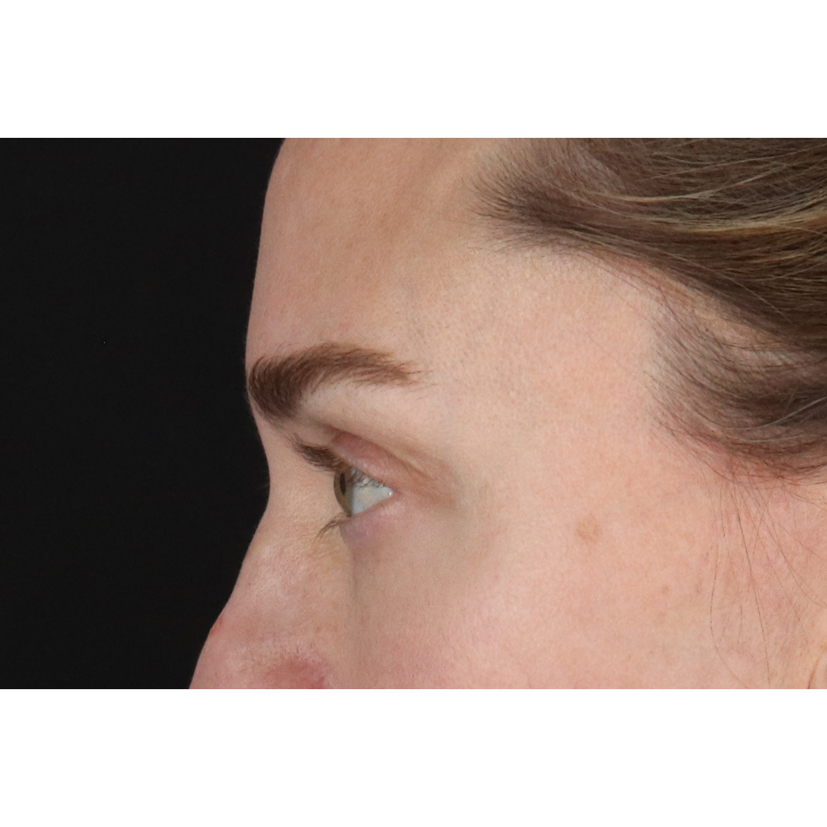 Blepharoplasty (Eyelid Surgery) Before & After Patient #11541