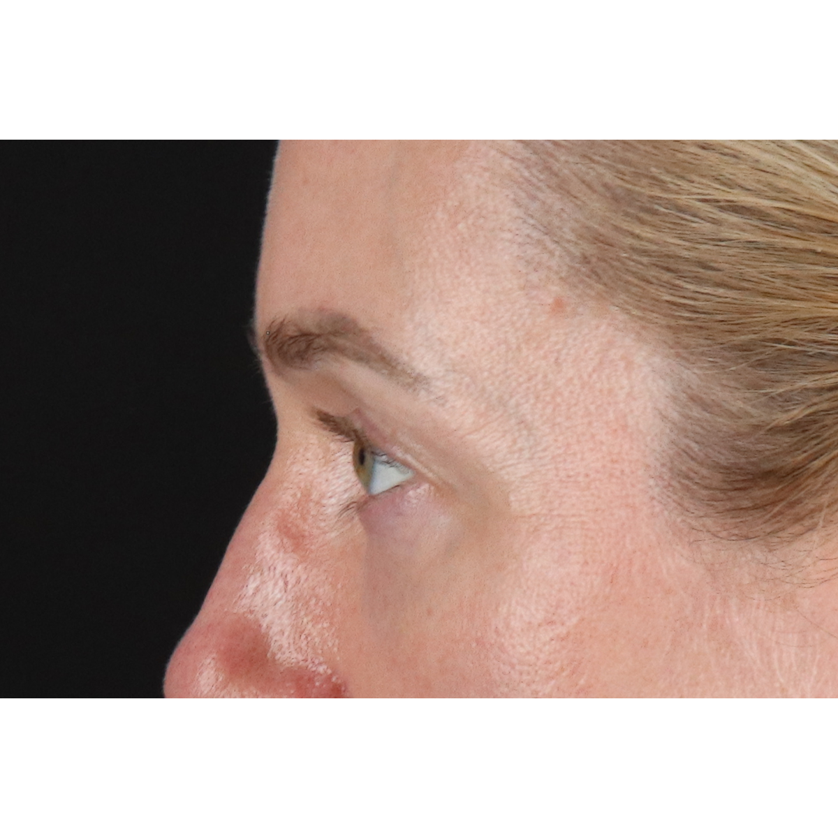Blepharoplasty (Eyelid Surgery) Before & After Patient #11883