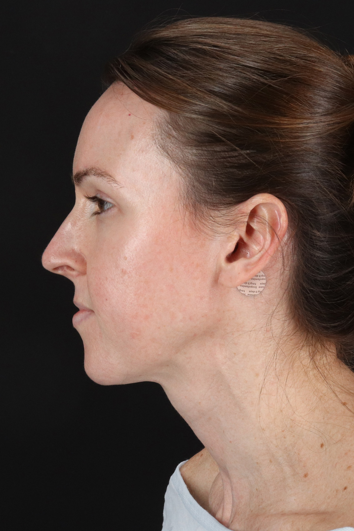 Fat Grafting To The Face Before & After Patient #11974