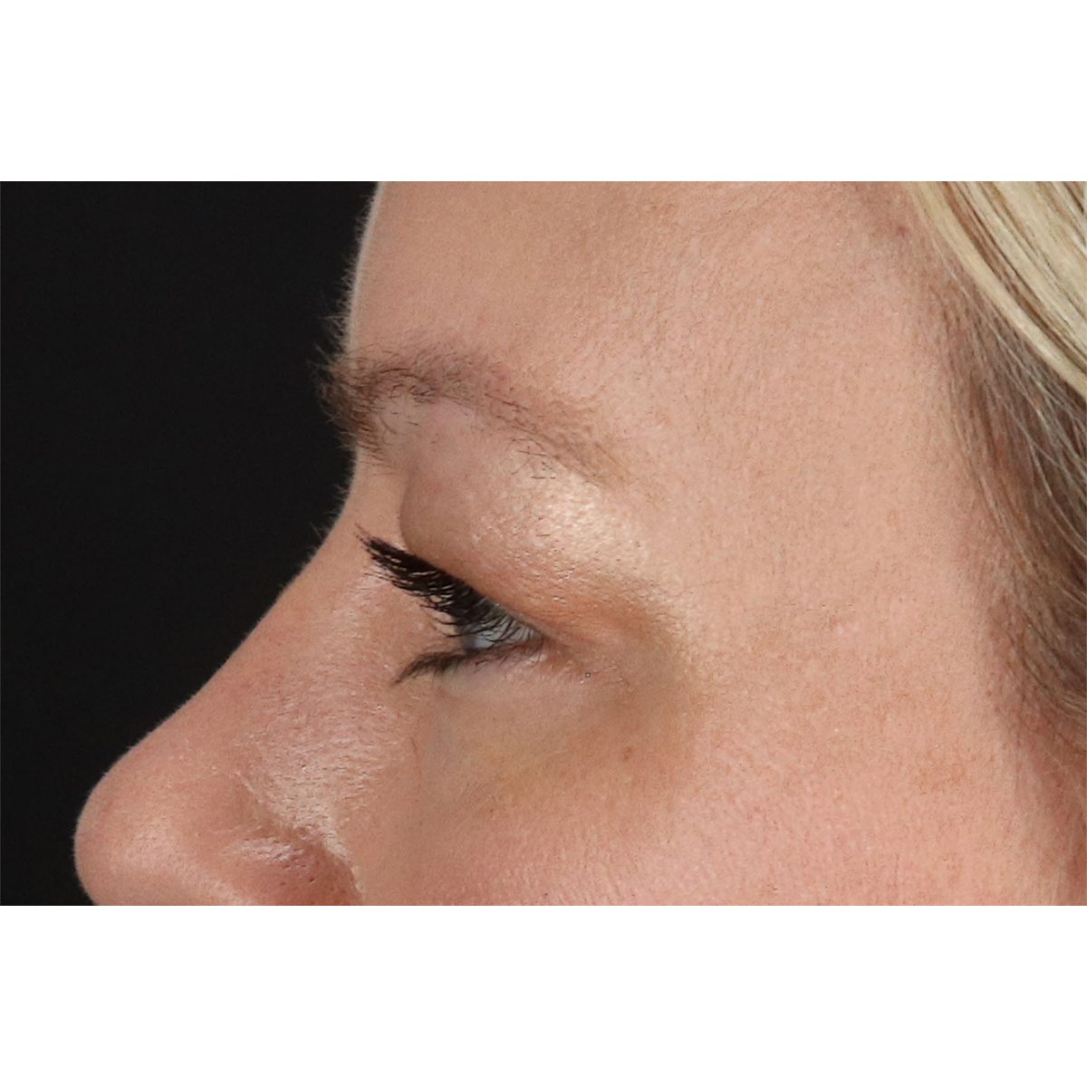 Blepharoplasty (Eyelid Surgery) Before & After Patient #11048
