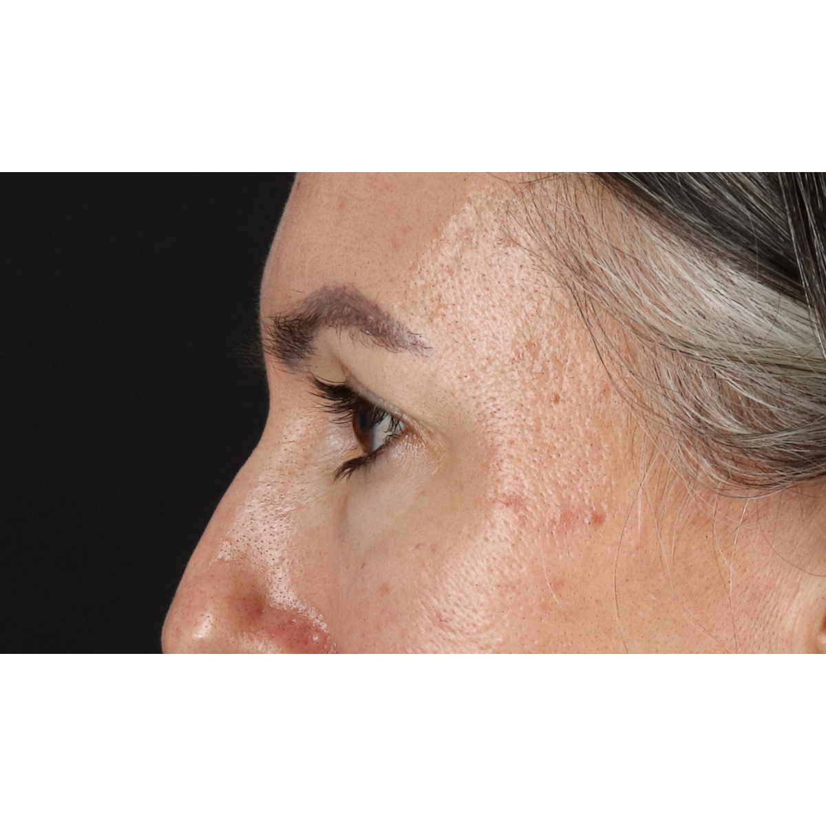Blepharoplasty (Eyelid Surgery) Before & After Patient #11282