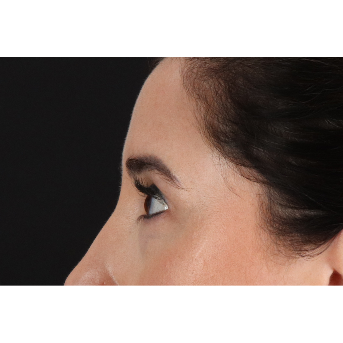Blepharoplasty (Eyelid Surgery) Before & After Patient #11668